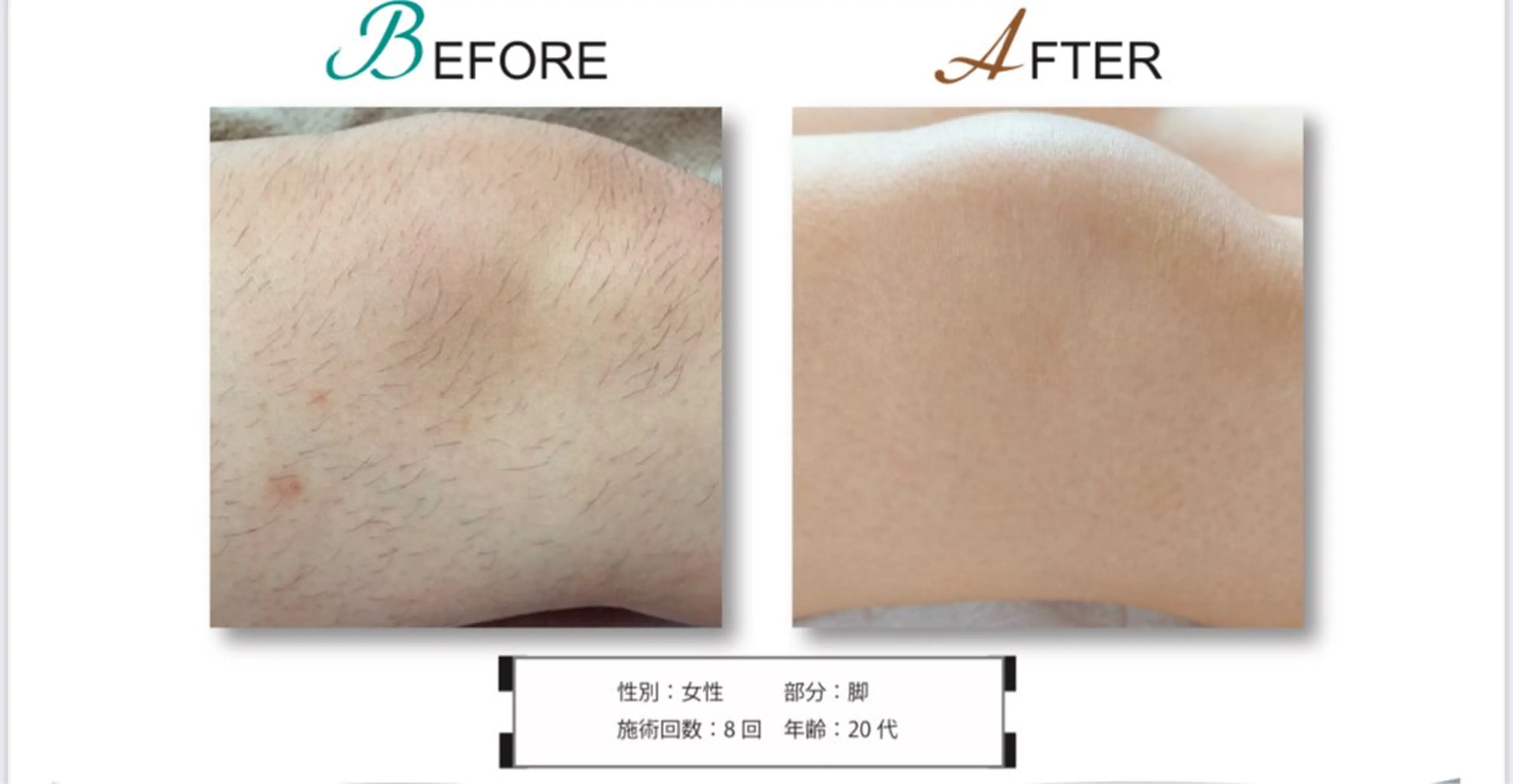 太もも​〜​足先まで！足丸ごとプラン⭐︎2回施術分⭐︎の写真