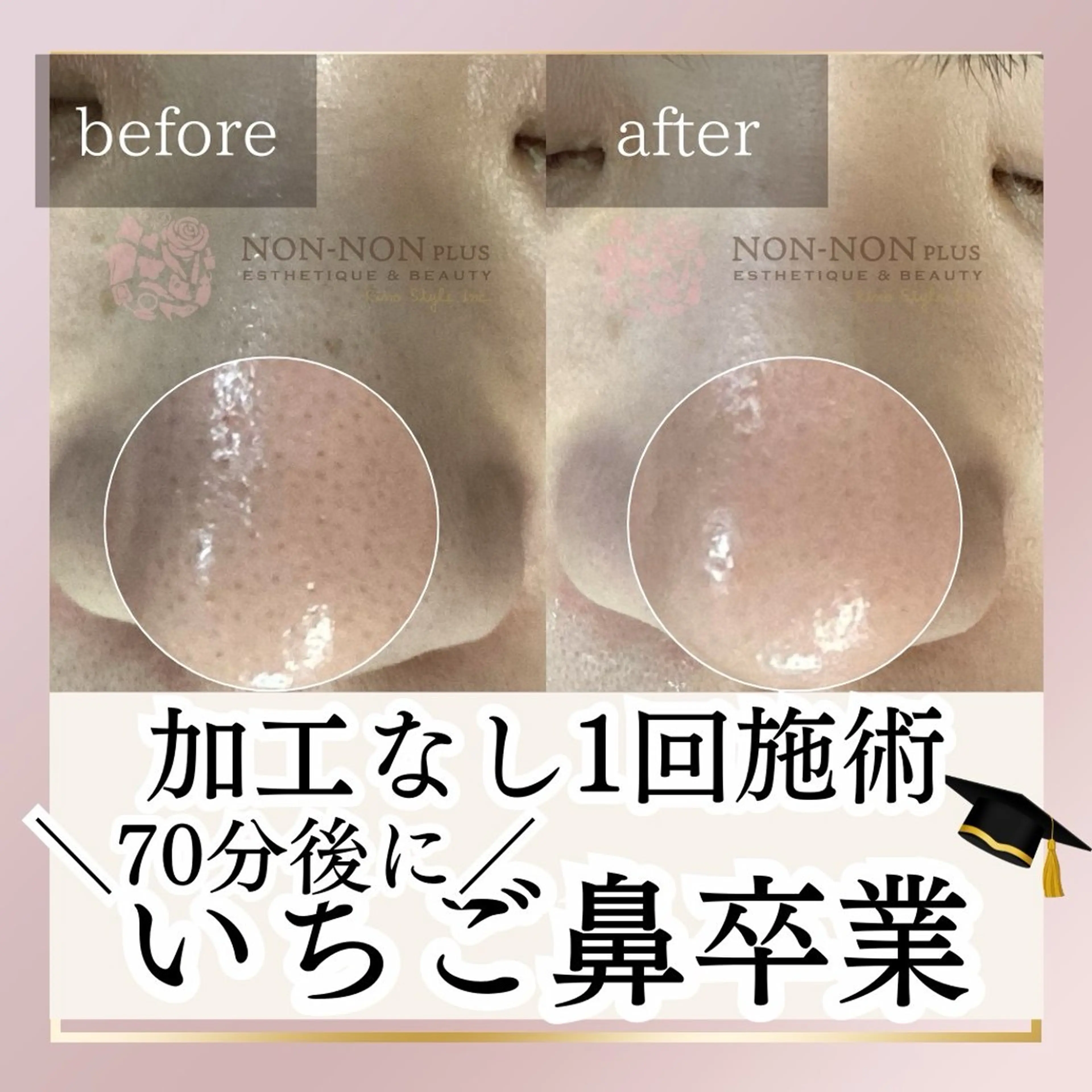 【70分でいちご鼻卒業🎓】鼻の黒ずみ毛穴がツルツルに✨70分11,000円→初回7,700円💆‍♀️の写真
