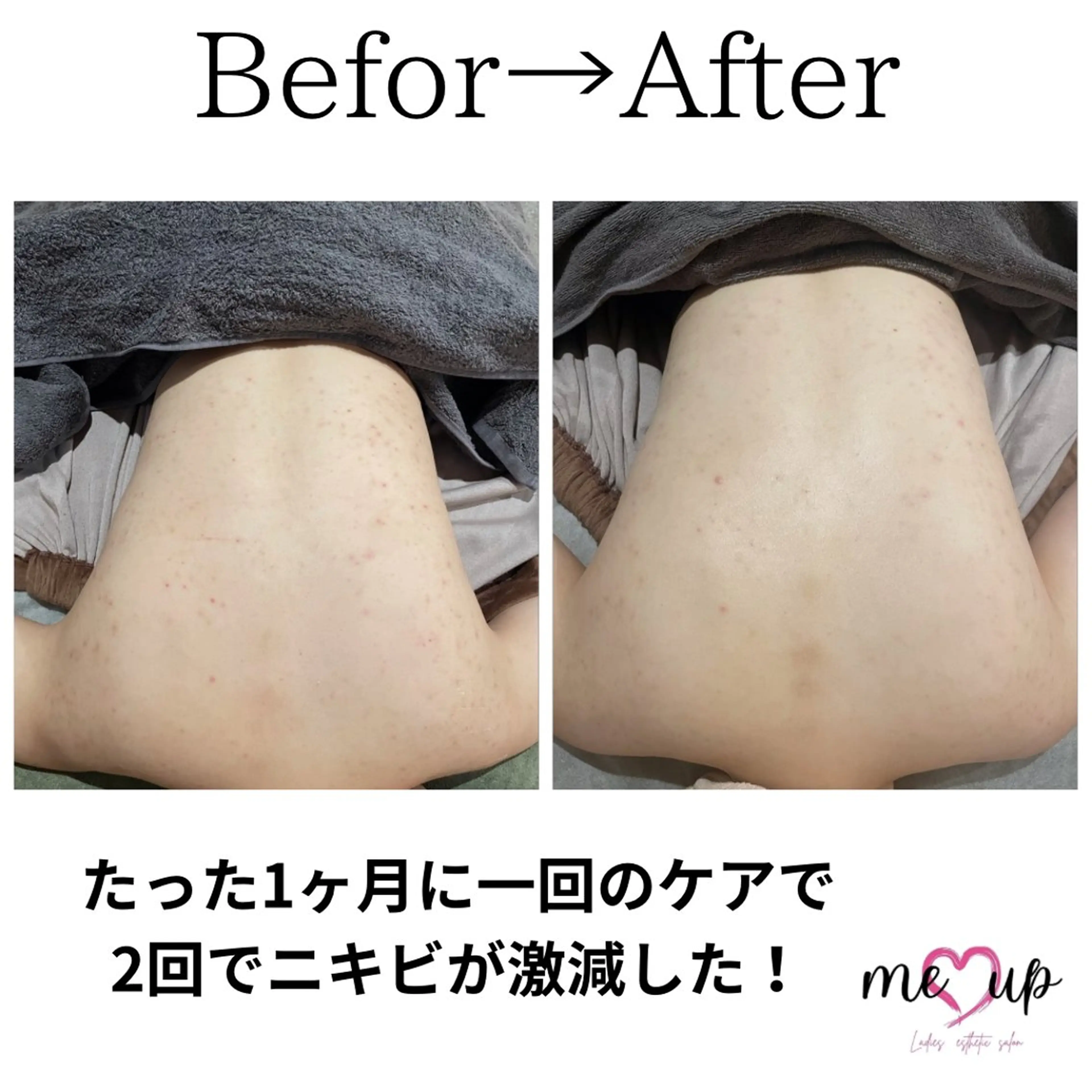 エステ Meupニキビ専門店 背中/ハーブ/肌管理のその他イメージ