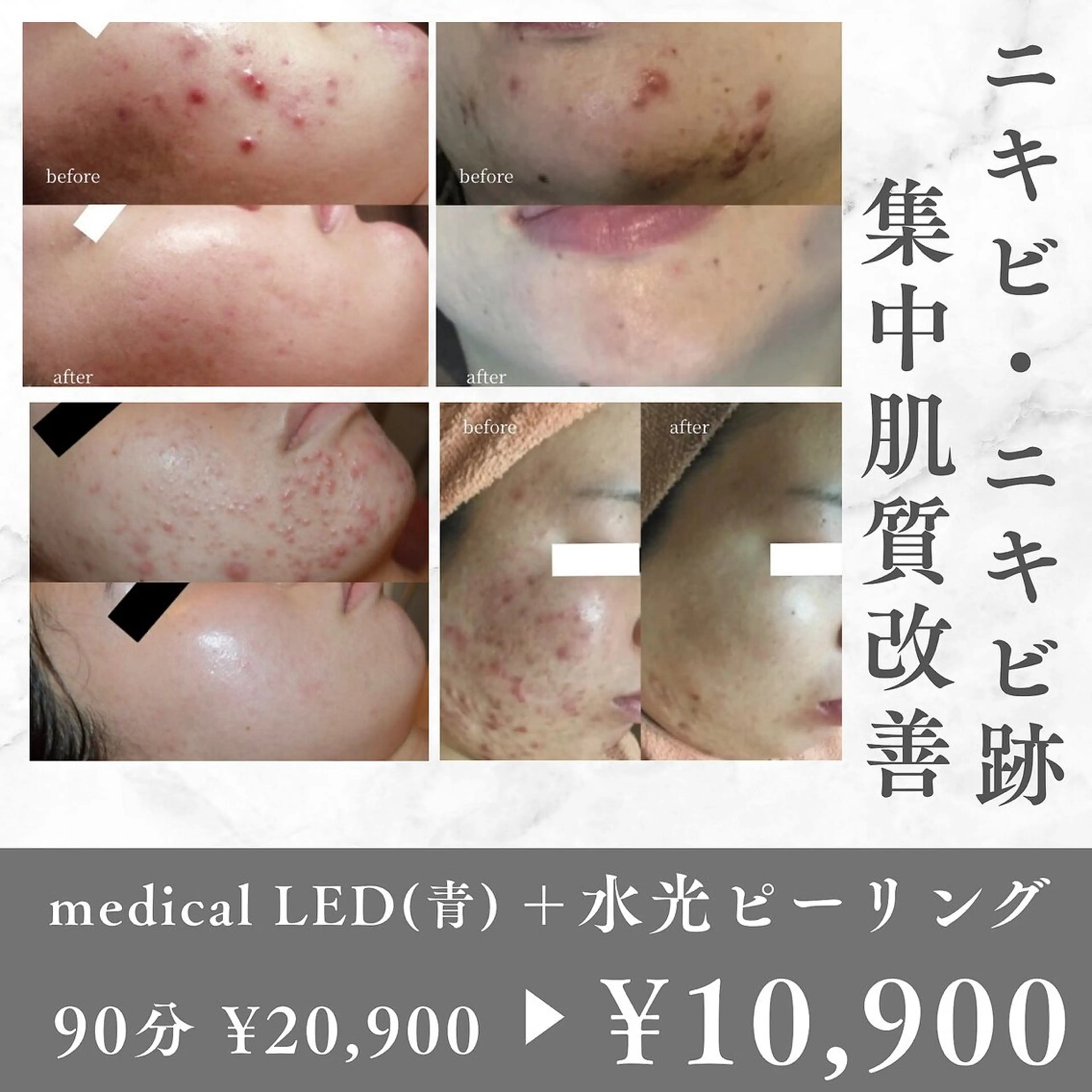 【ニキビ集中改善】韓国LED(青)＋水光ピーリング　¥20,900→¥10,900の写真