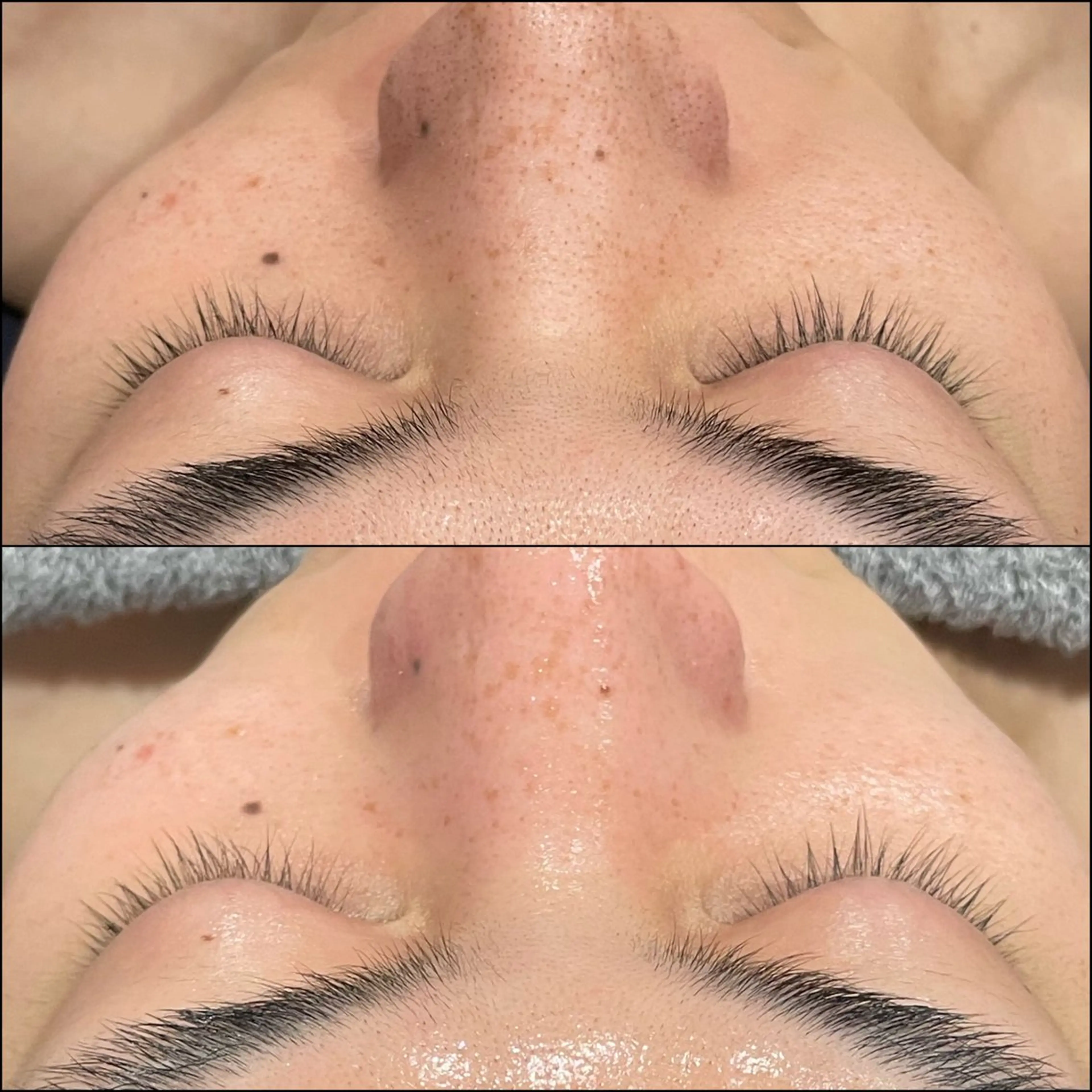 【毛穴撃退】黒ずみ・角栓ごっそりフェイシャルの写真