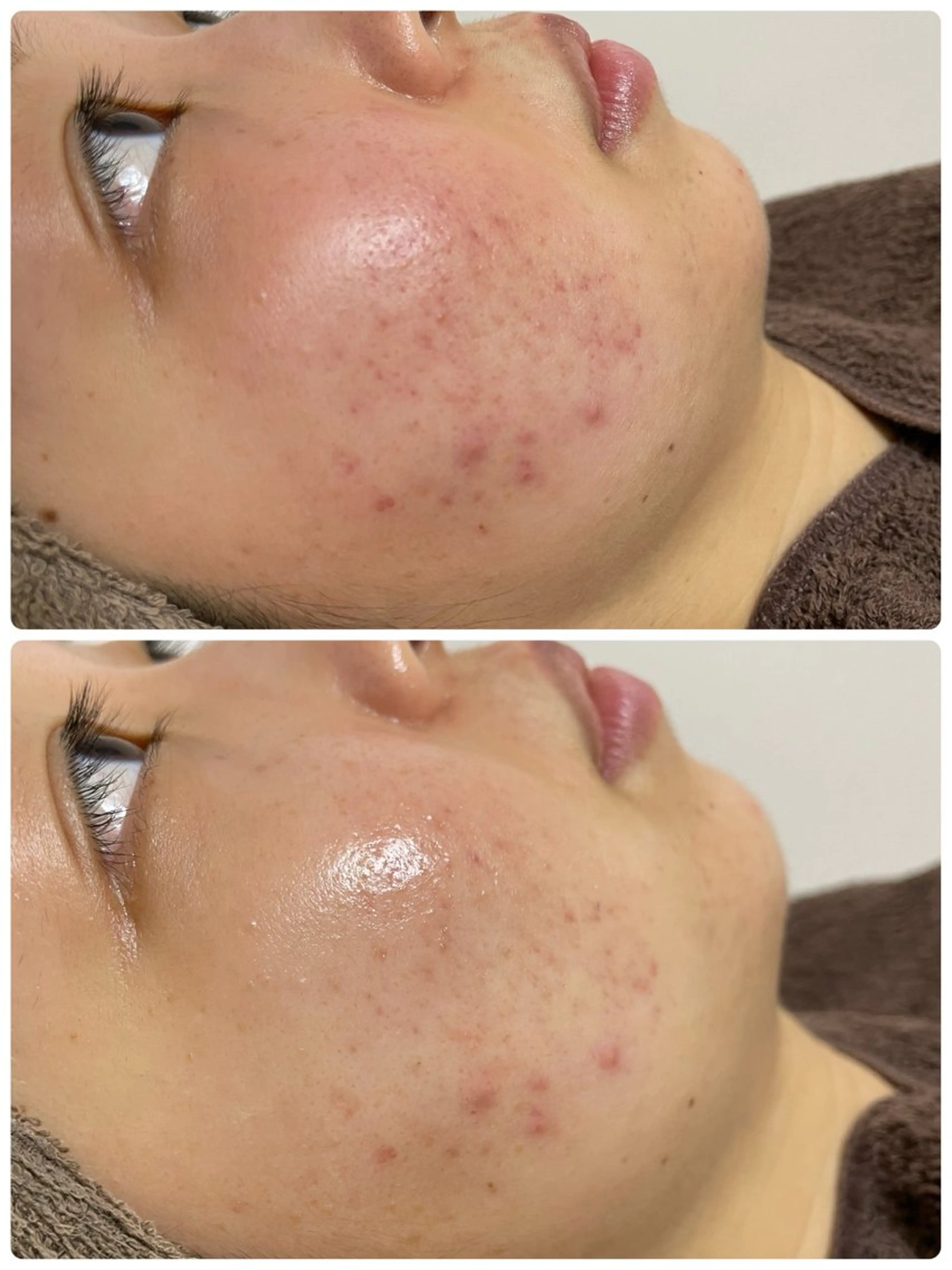 【肌質改善フェイシャルＮｏ．1】韓国美肌☆ハーブピーリング￥23100を￥18000の写真