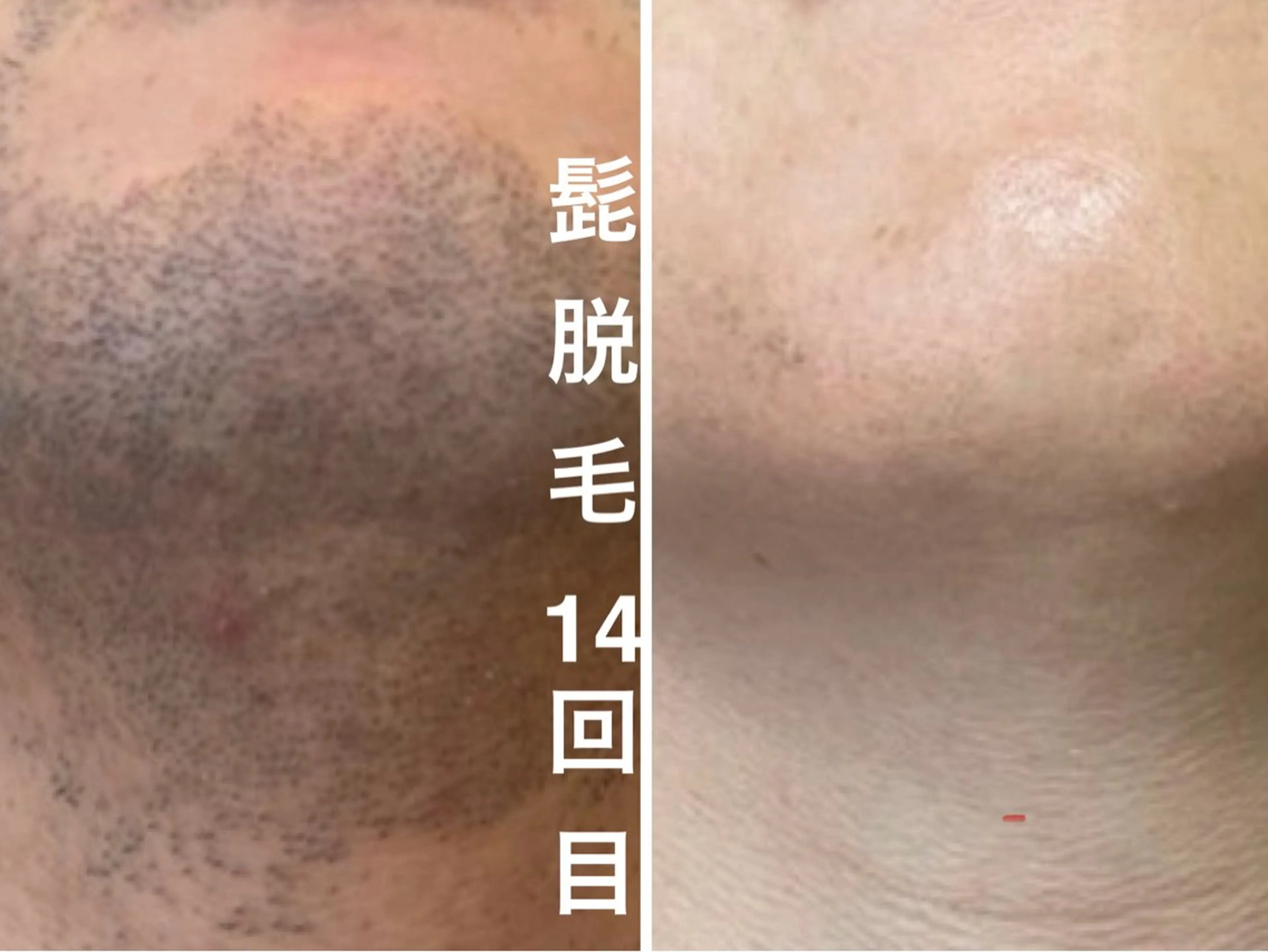 メンズ 肌管理脱毛ピーリング CDFAkasakaのエステ・リラクイメージ