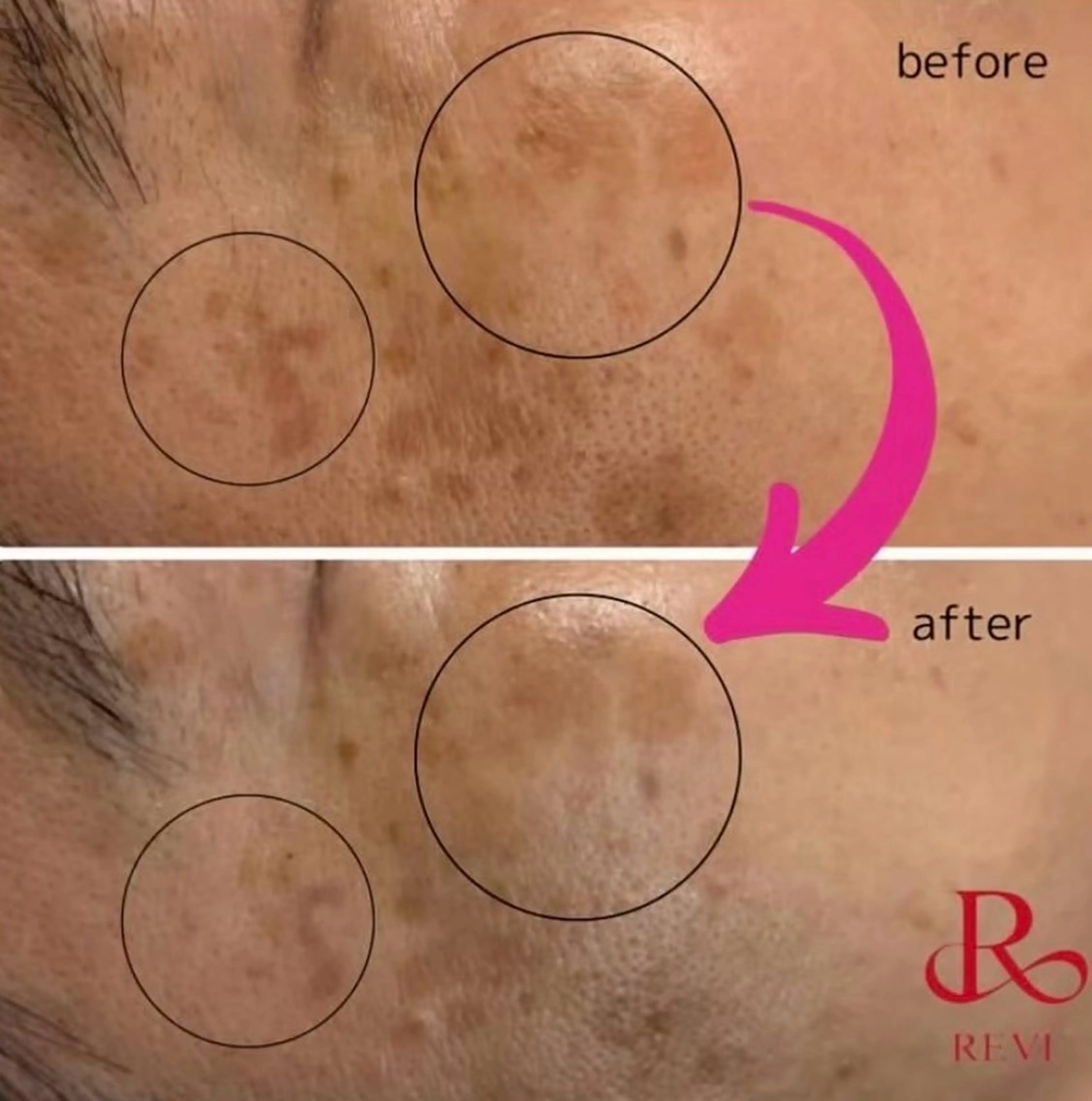 【REVIマシン】光フェイシャルでトラブル肌改善☆鎮静パックプレゼント付🎁の写真