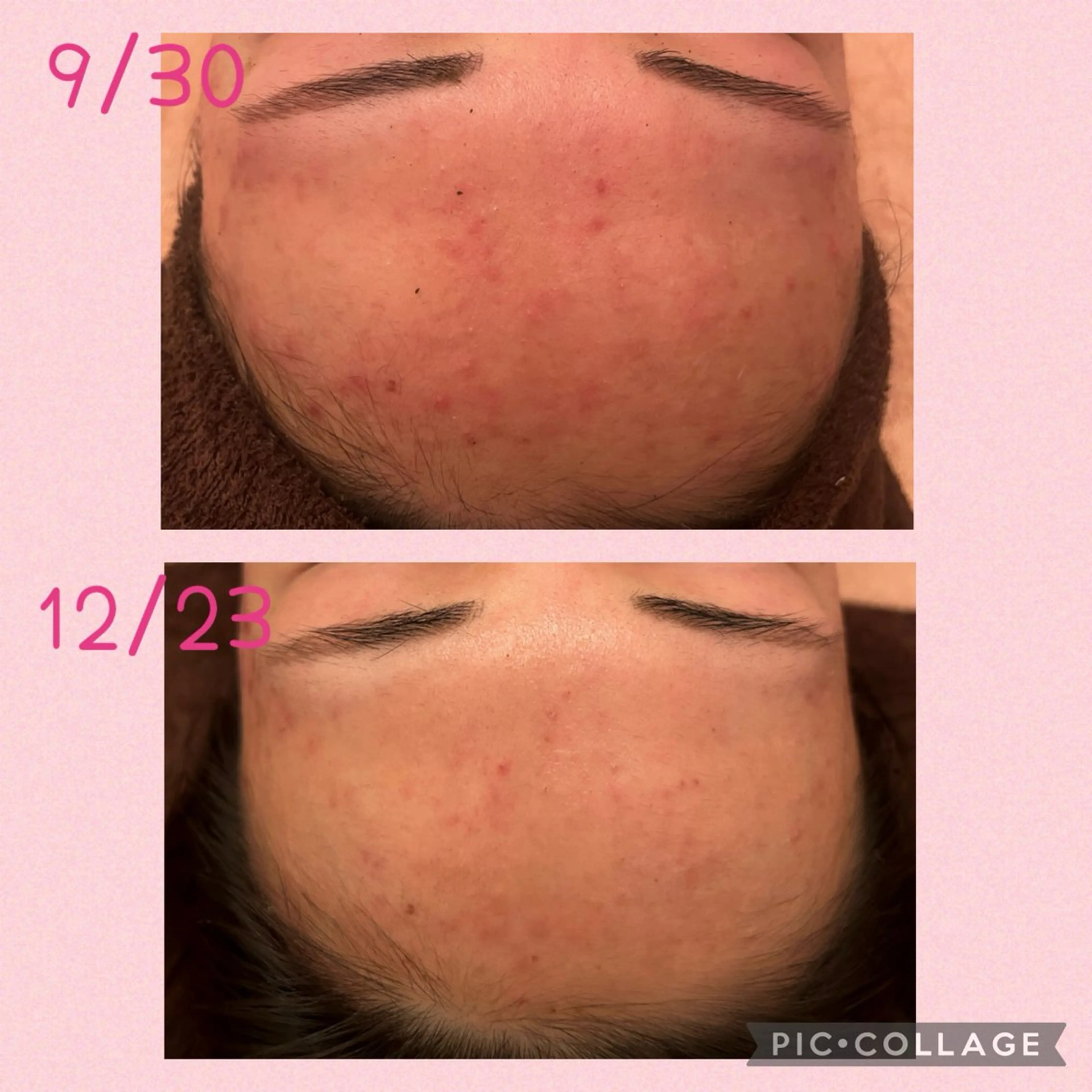 3/25迄ハーブ ピーリングBloomのエステ・リラクイメージ