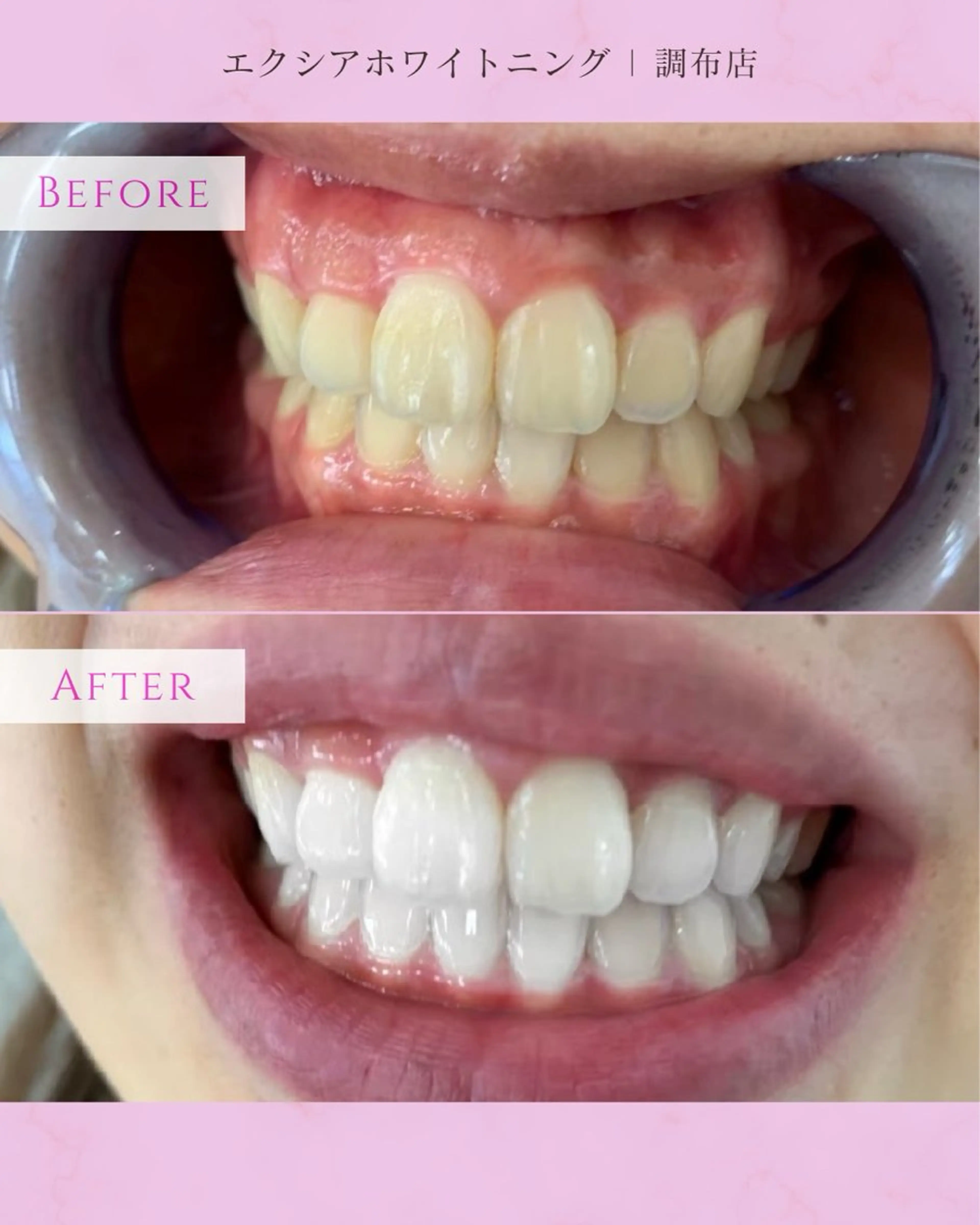 エクシアホワイト調布所属・yumi❤︎ ホワイトニングのその他イメージ