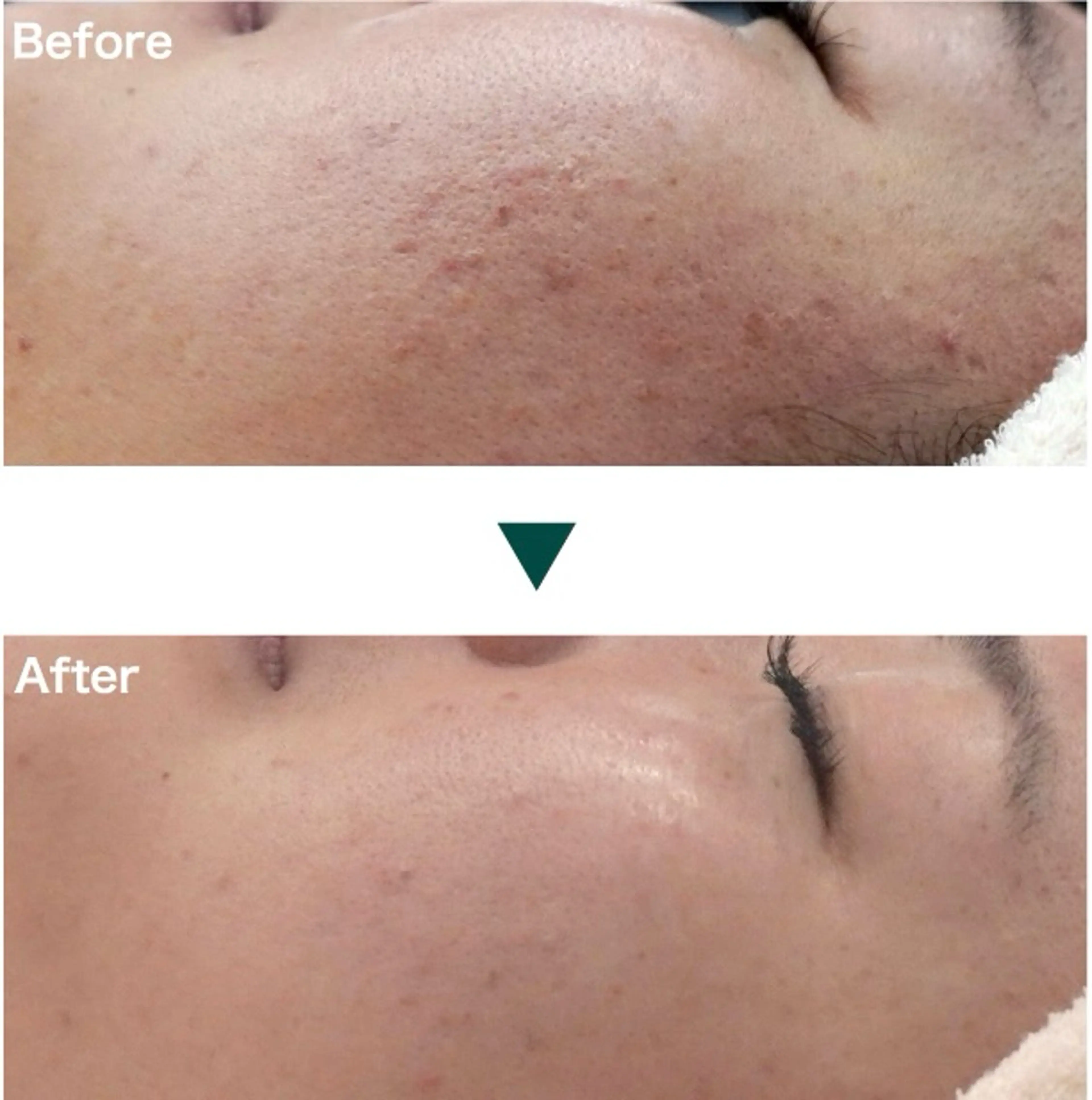 『大人ニキビ』ピーリング✖️身体を整えるトリートメントの写真