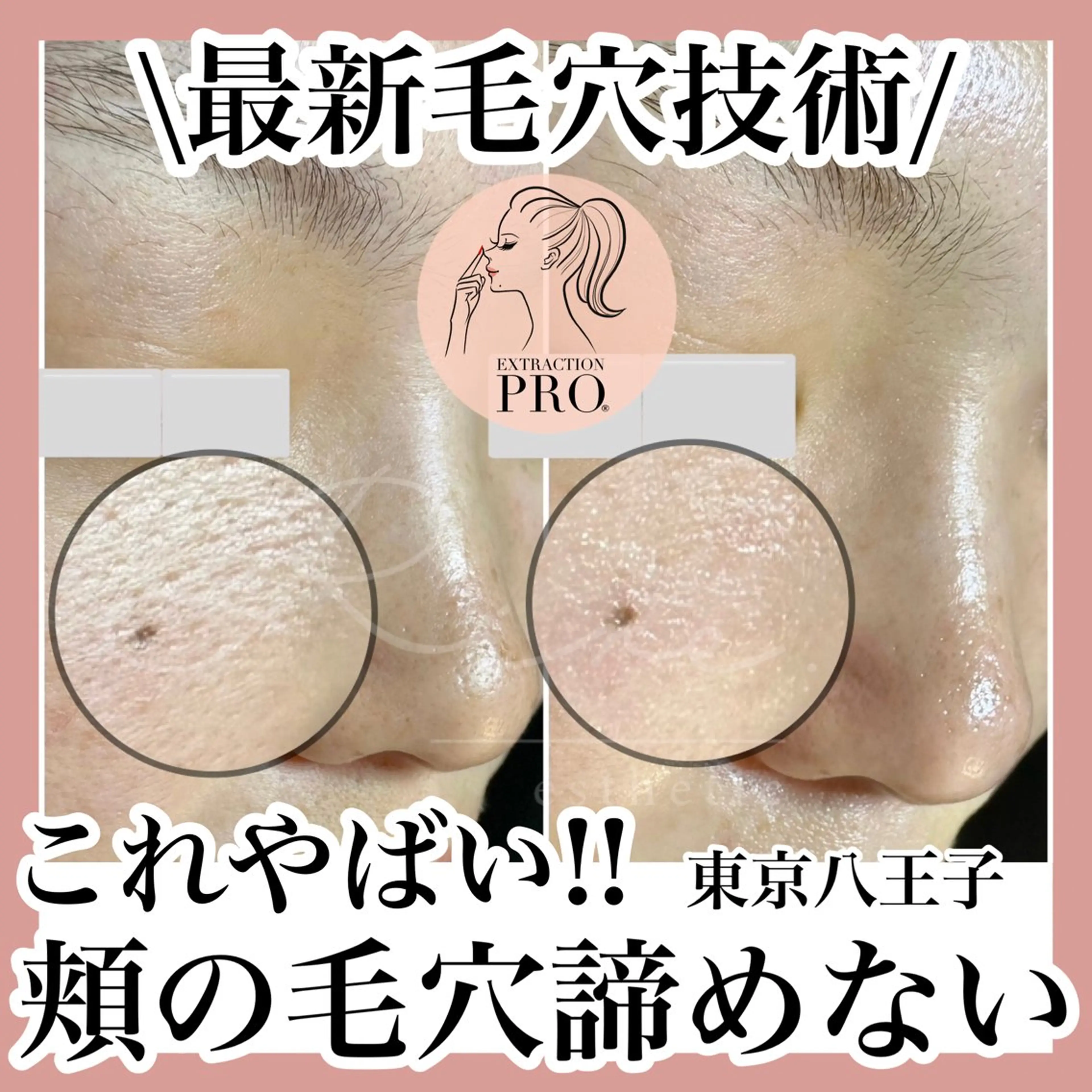 毛穴特化エステ -リールのエステ・リラクイメージ