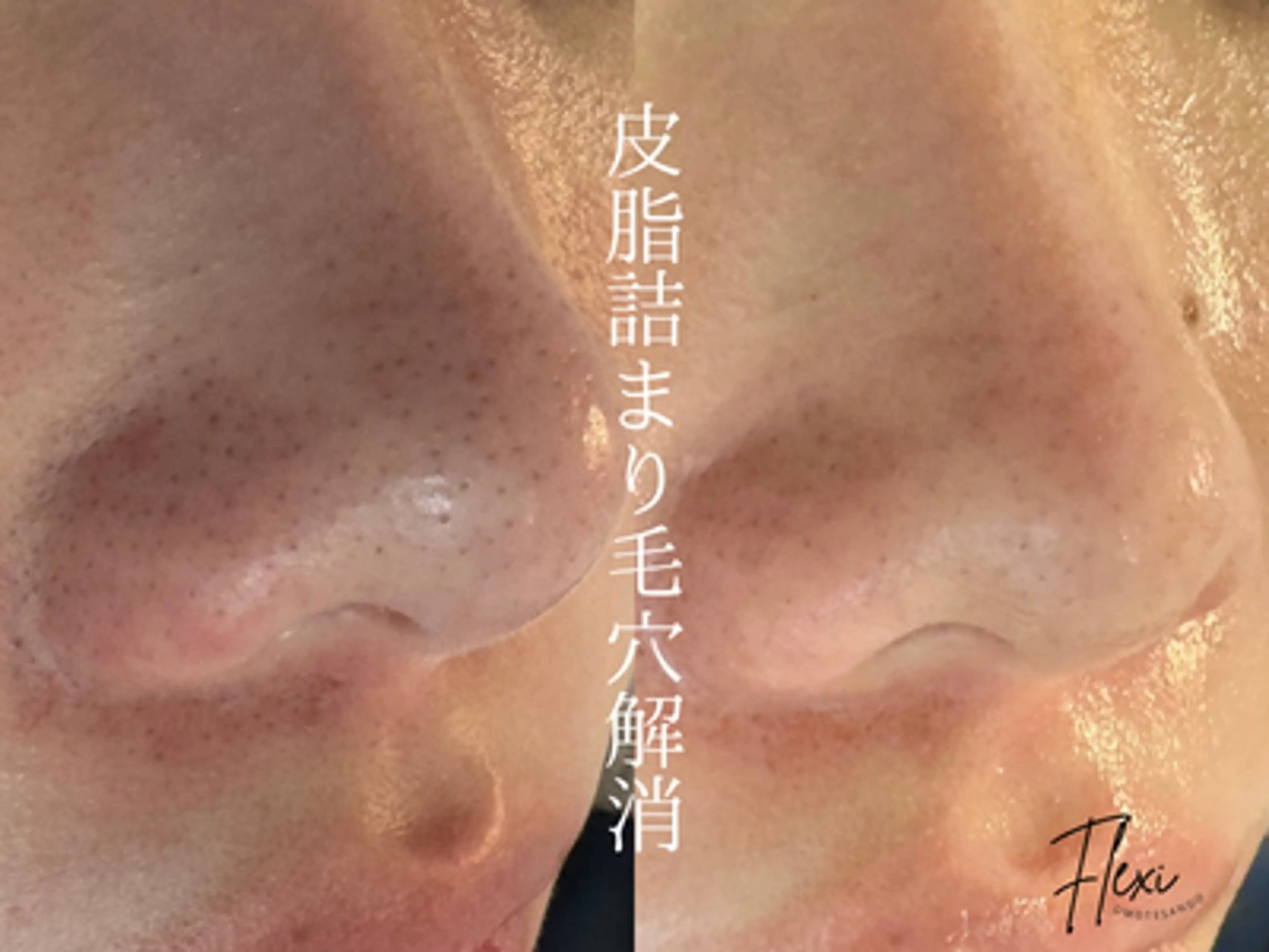 🌟ニキビ・毛穴ケア 🌿Flexi表参道のエステ・リラクイメージ