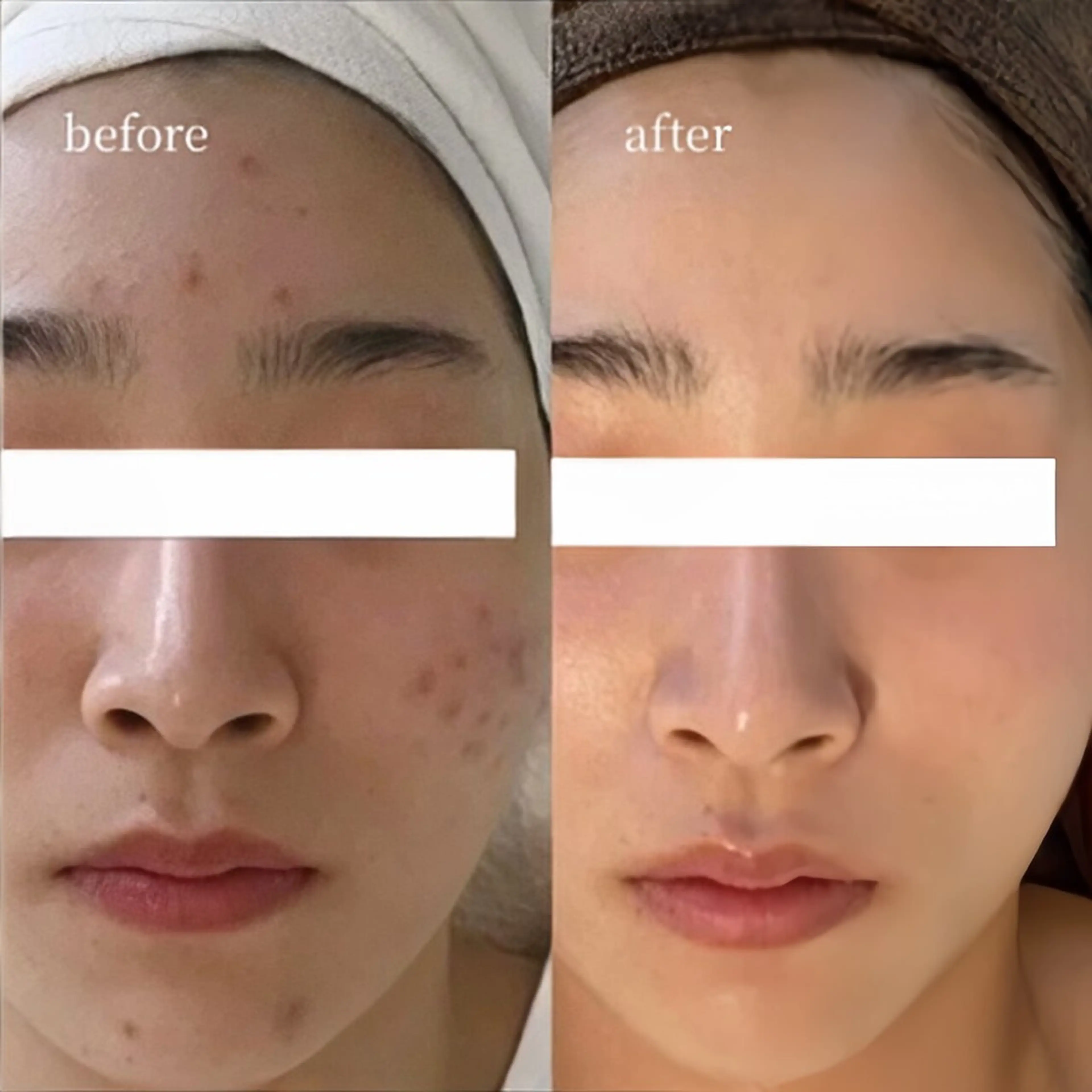 平日限定【圧倒的人気No. 1】水光ピーリング ¥19,800→¥8,800の写真