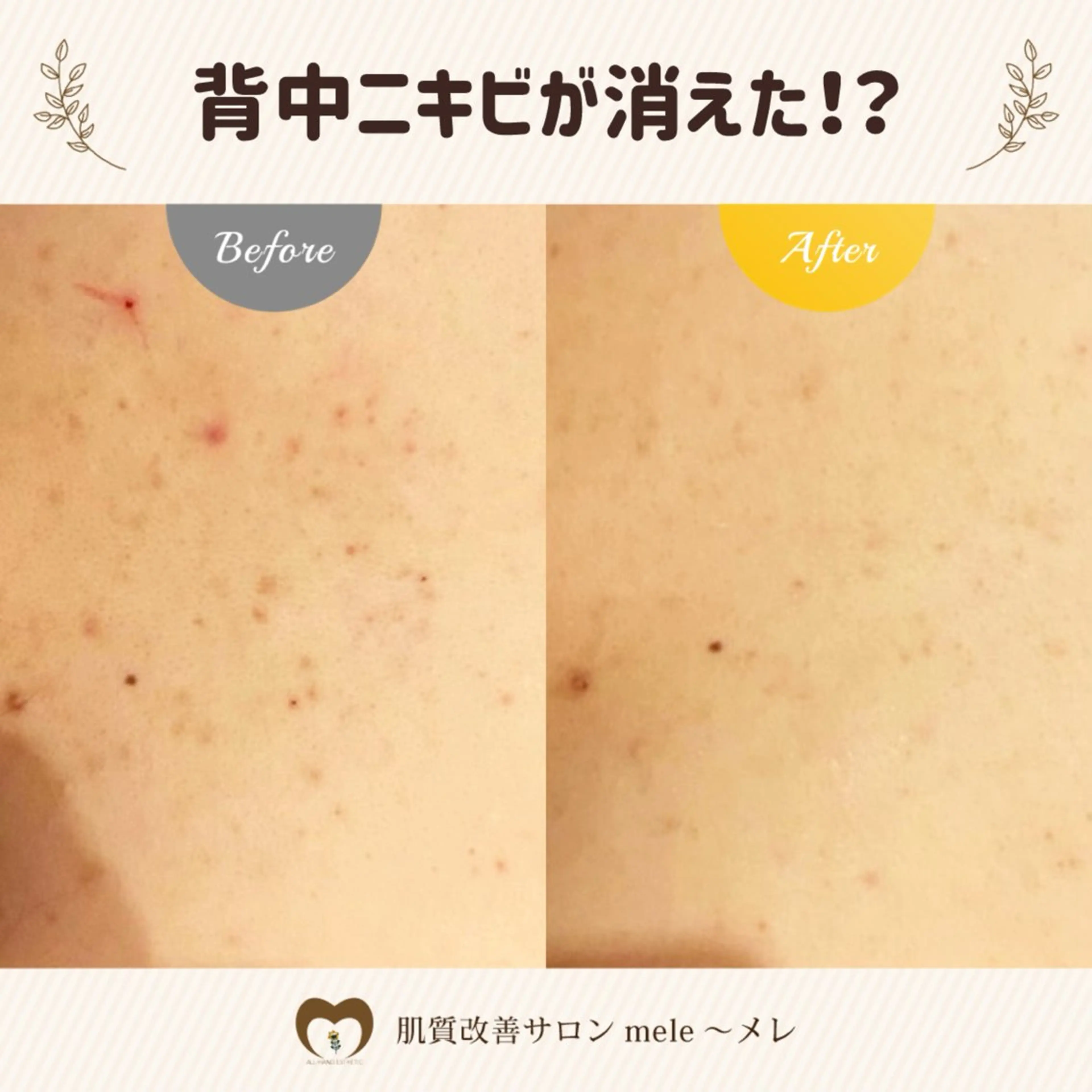 エステ リラク 繰り返すニキビ・毛穴 ✨つくば肌質改善専門のエステ・リラクイメージ