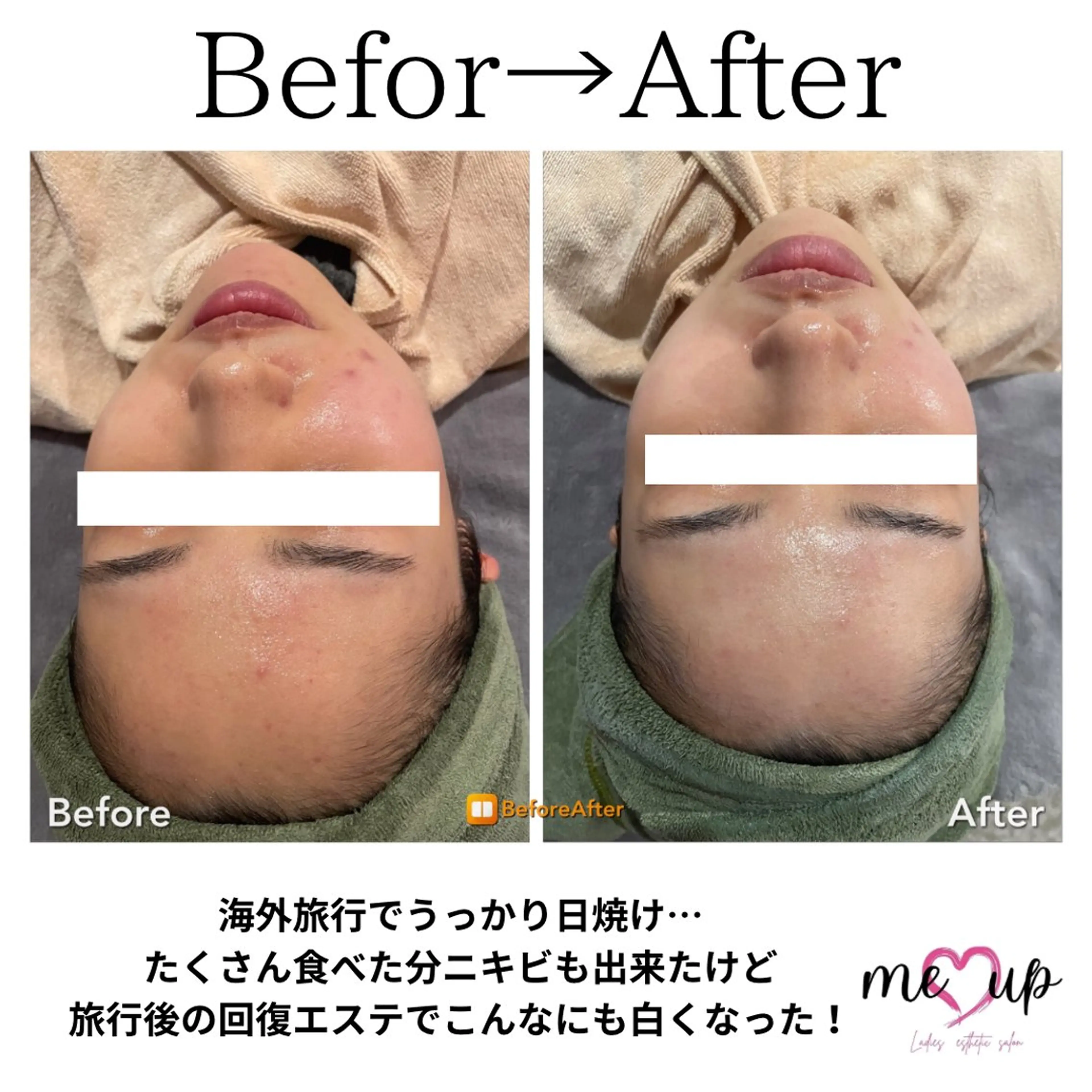 Meupニキビ専門店 背中/ハーブ/肌管理のその他イメージ