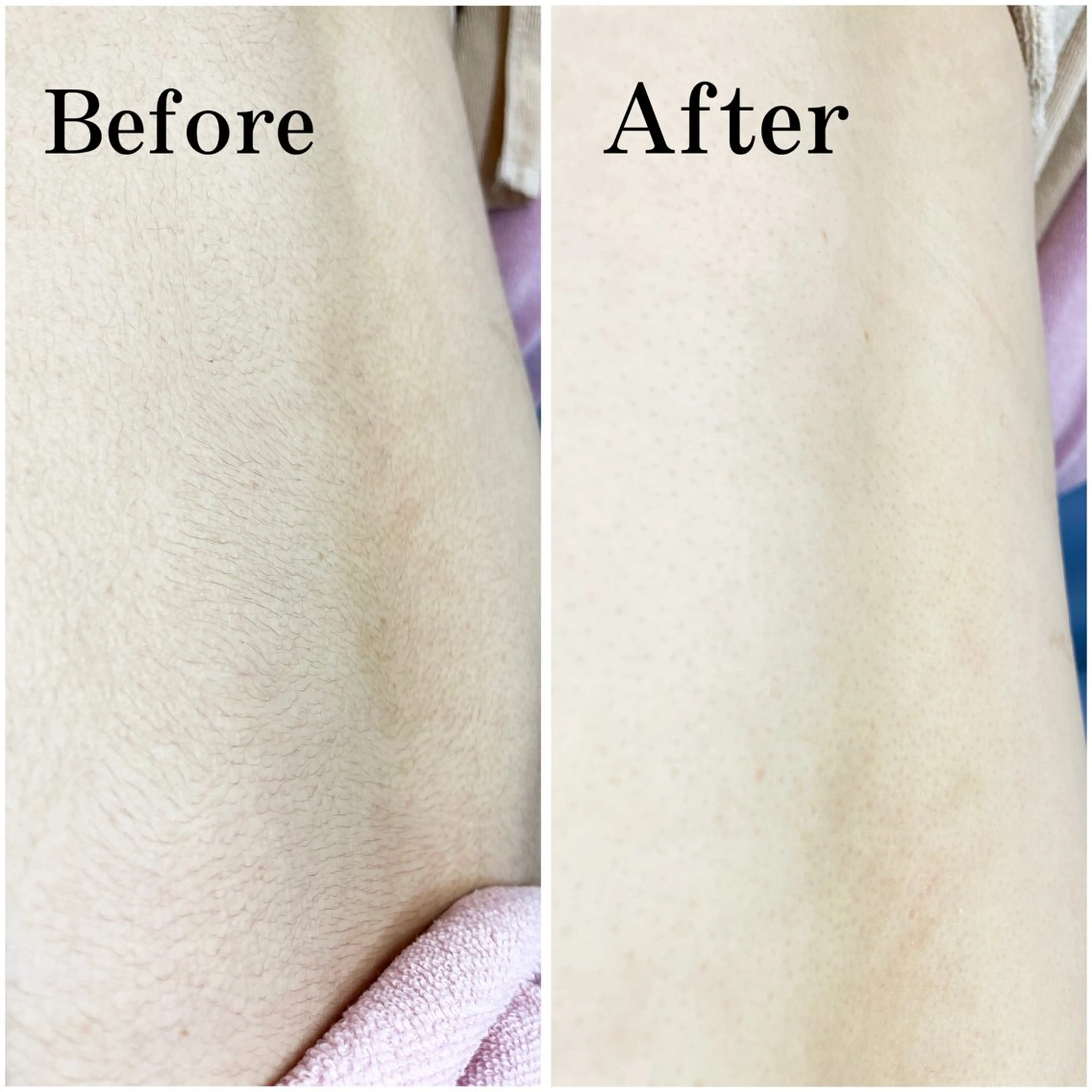 💛背中全体シェービング+背中全体パックの写真