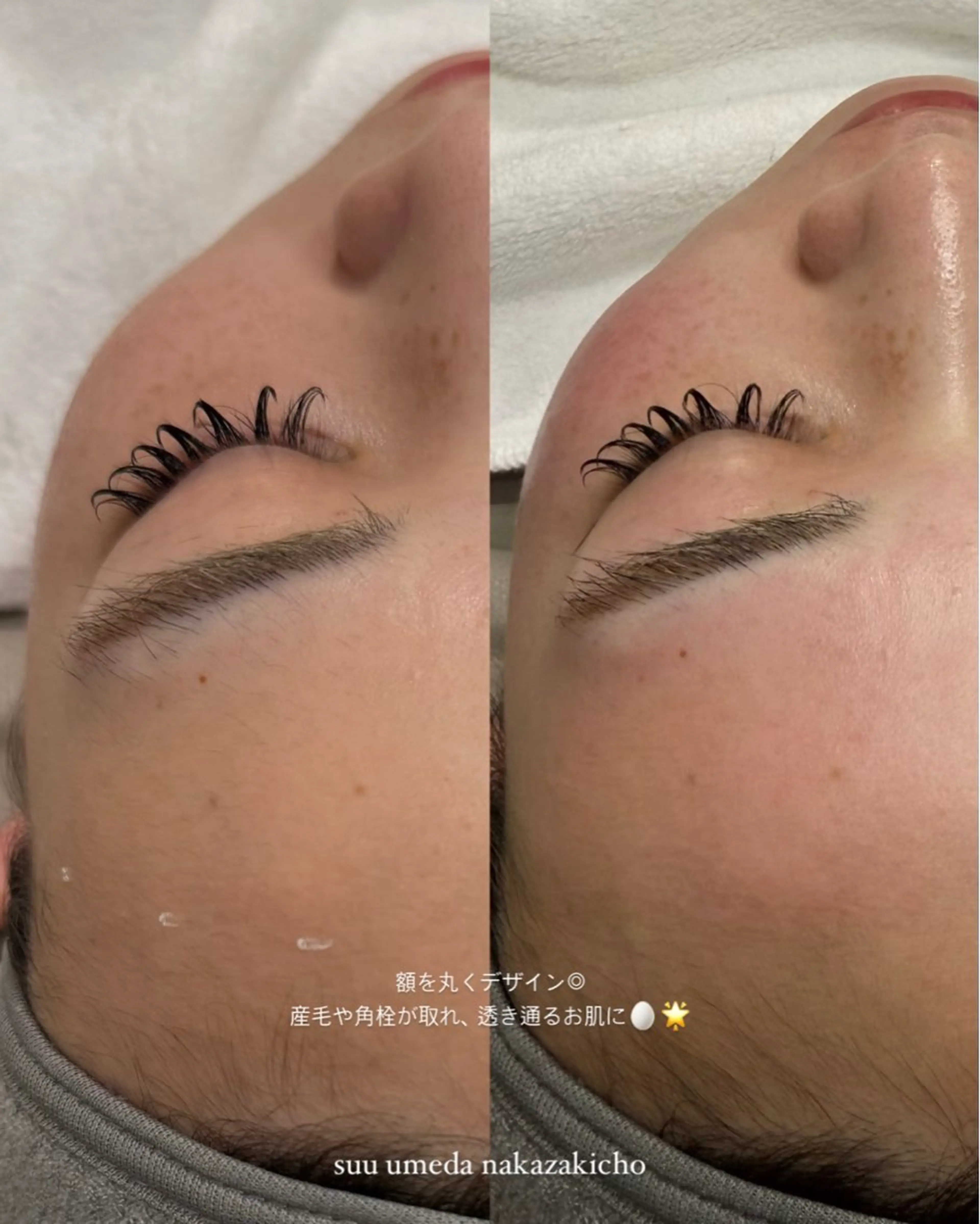 脱毛 suu ｜harukaのマツエク・マツパデザイン