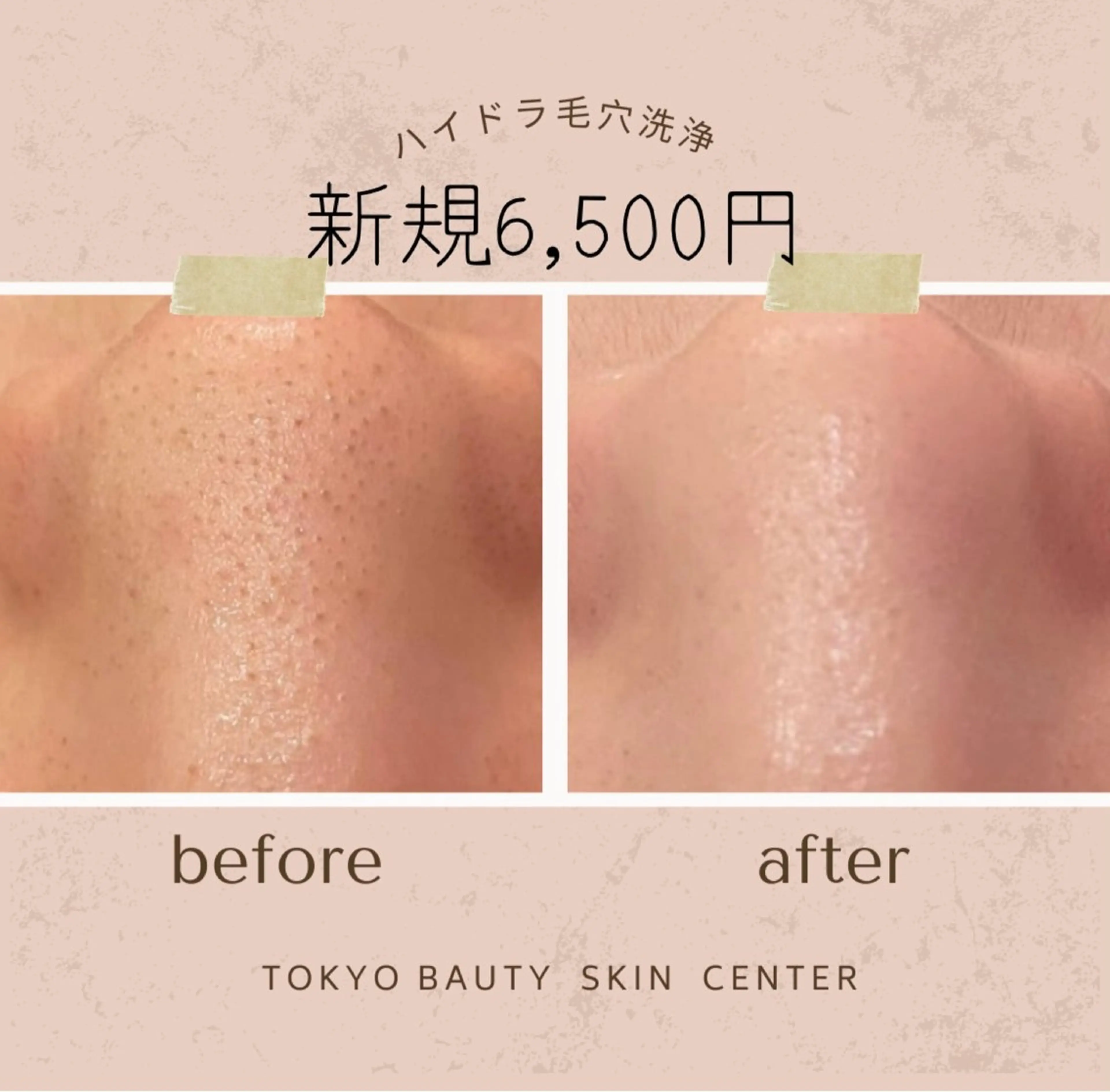 エステ 全身脱毛&毛穴洗浄 ビューティー五反田のエステ・リラクイメージ