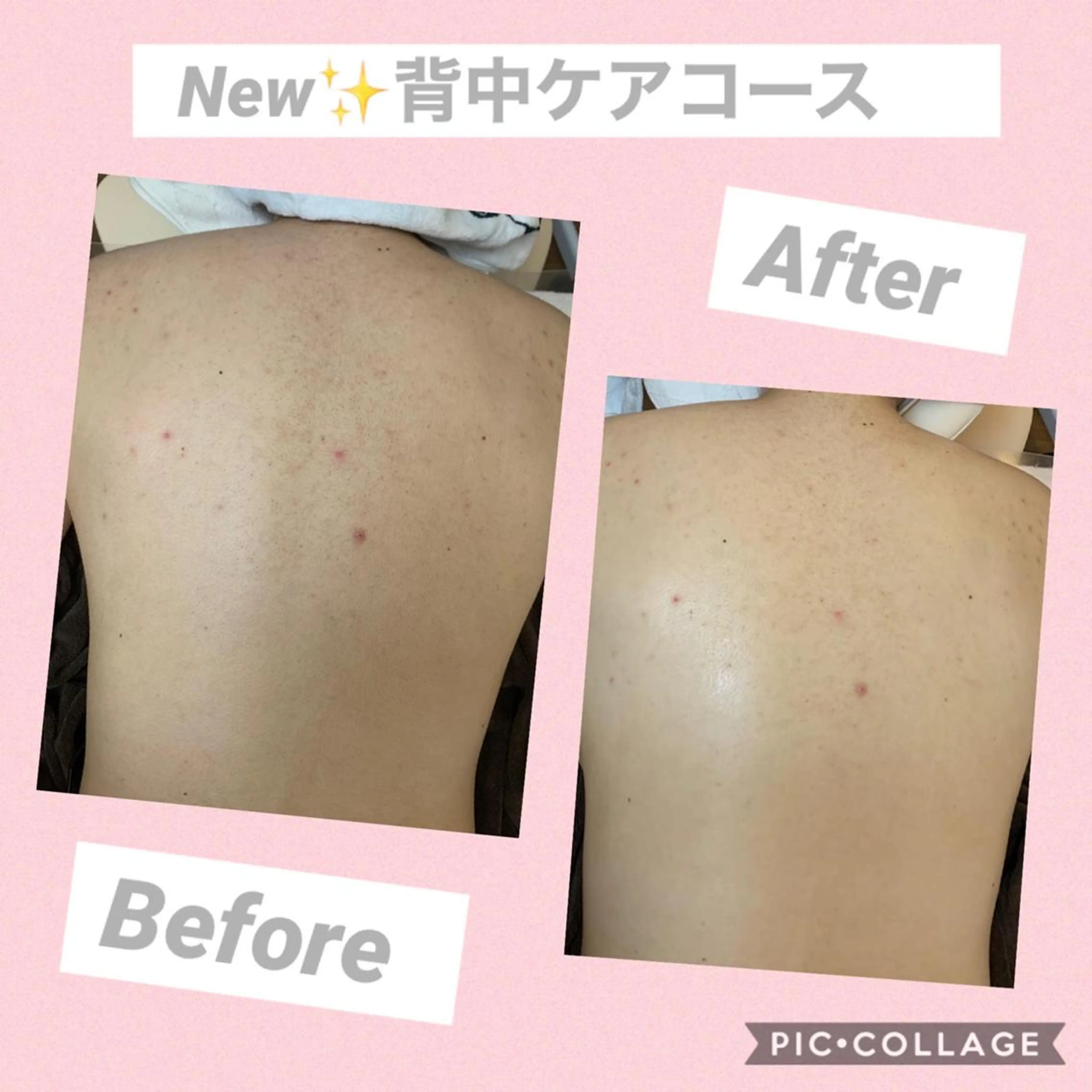 【ご新規様限定】🔸背中ケア美白コースの写真