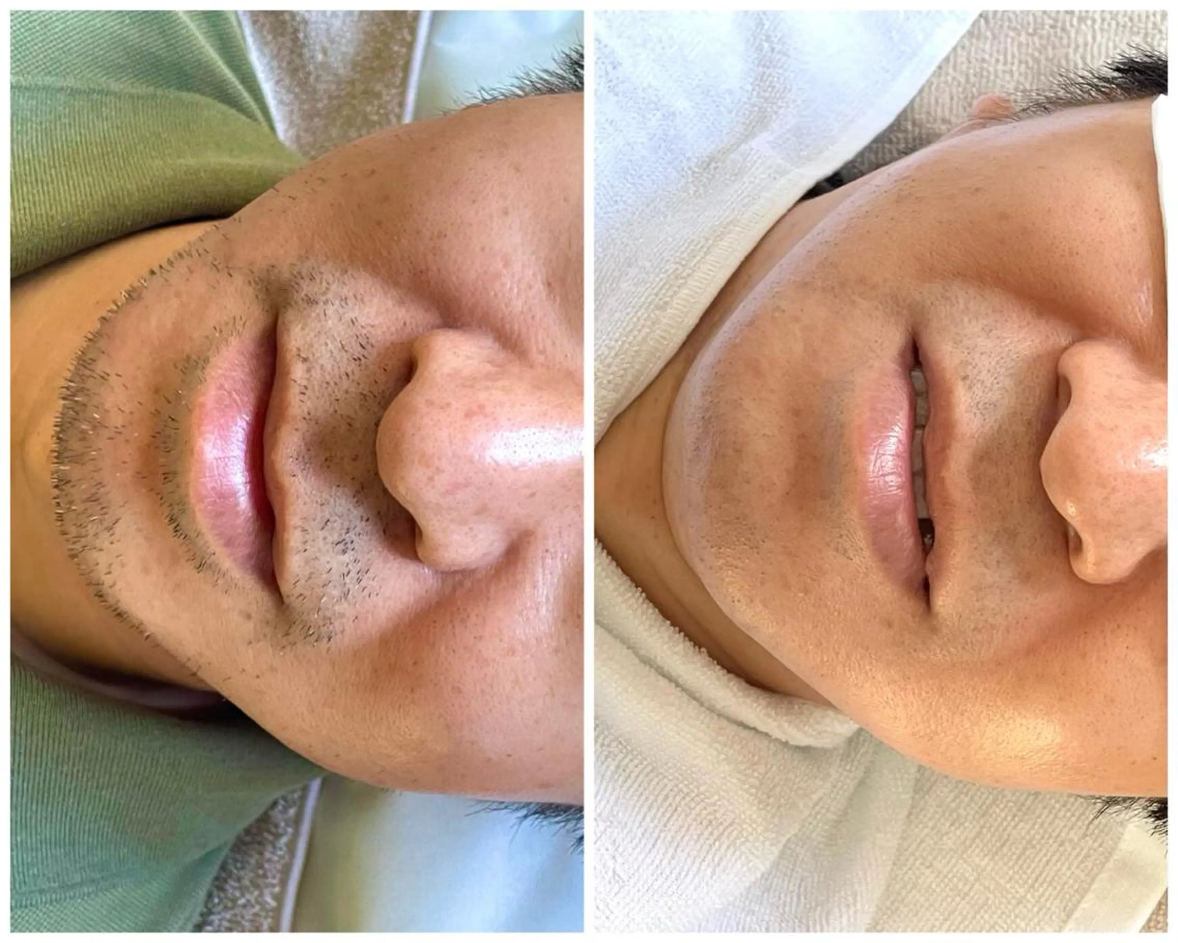 【NPL方式で効果が早い♪ヒゲ脱毛】初回体験1980円!濃いおヒゲに自信あり☆の写真