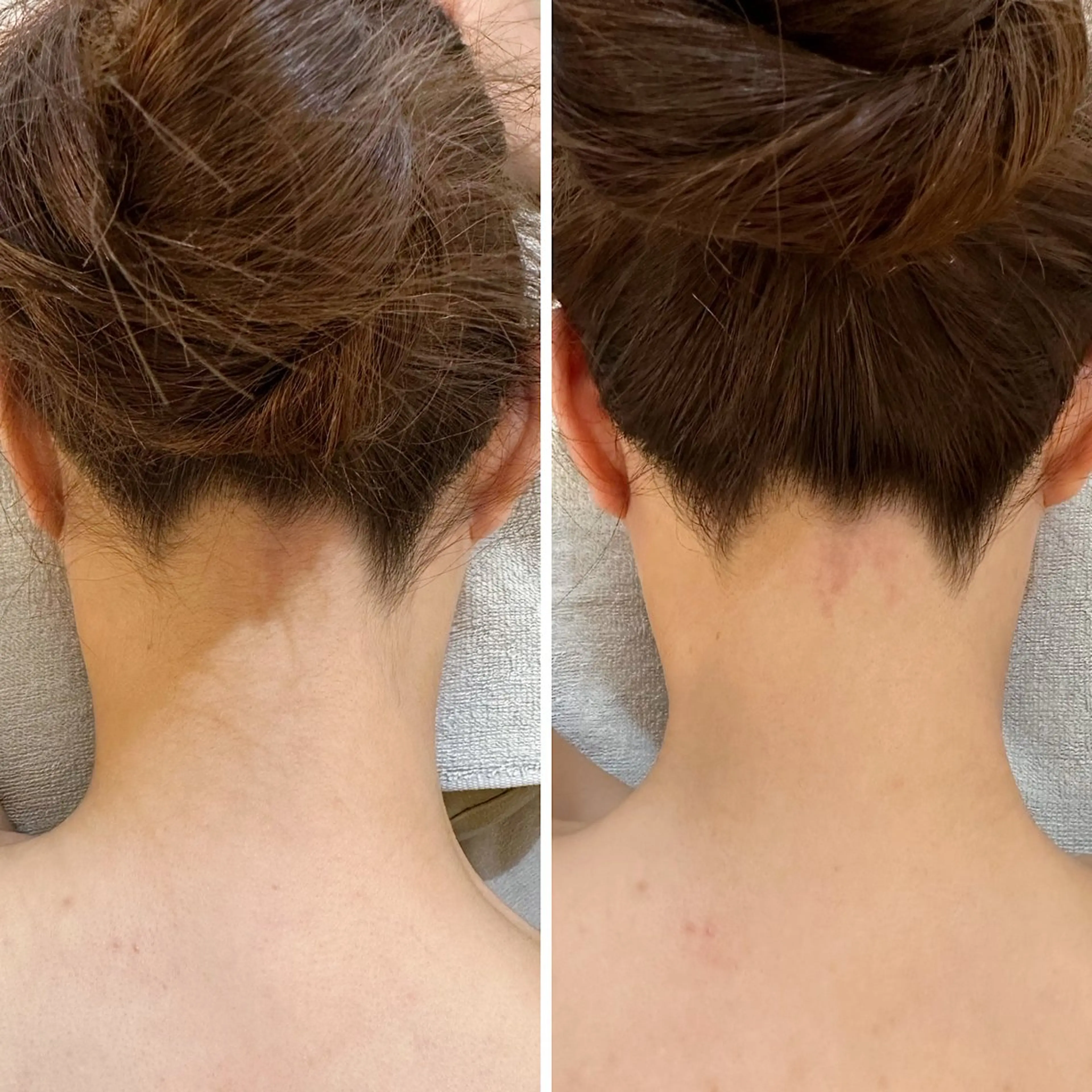 脱毛 うなじ脱毛/美肌脱毛 LABELのエステ・リラクイメージ