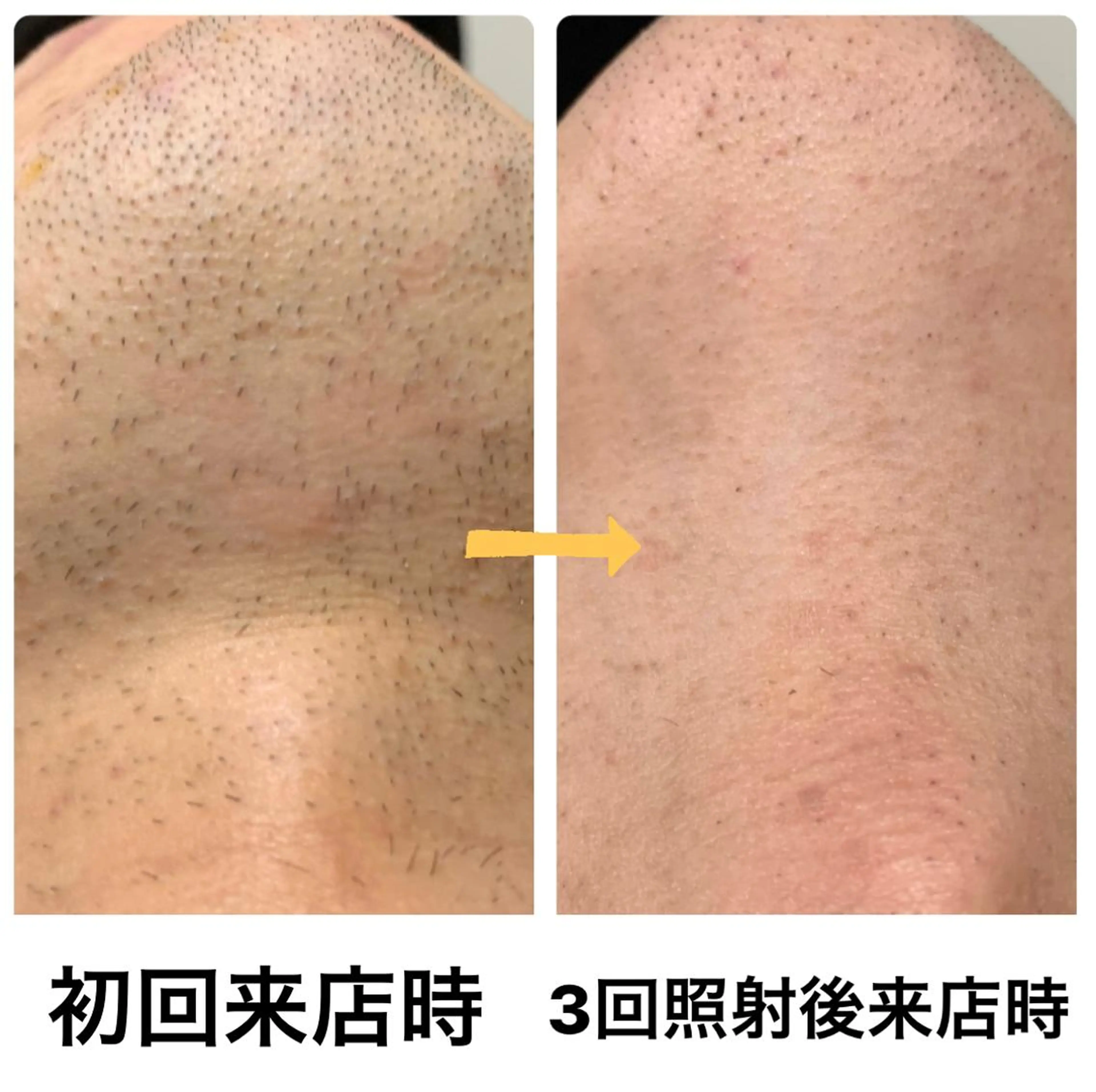 脱毛 メンズ脱毛サロン Le falcoのエステ・リラクイメージ