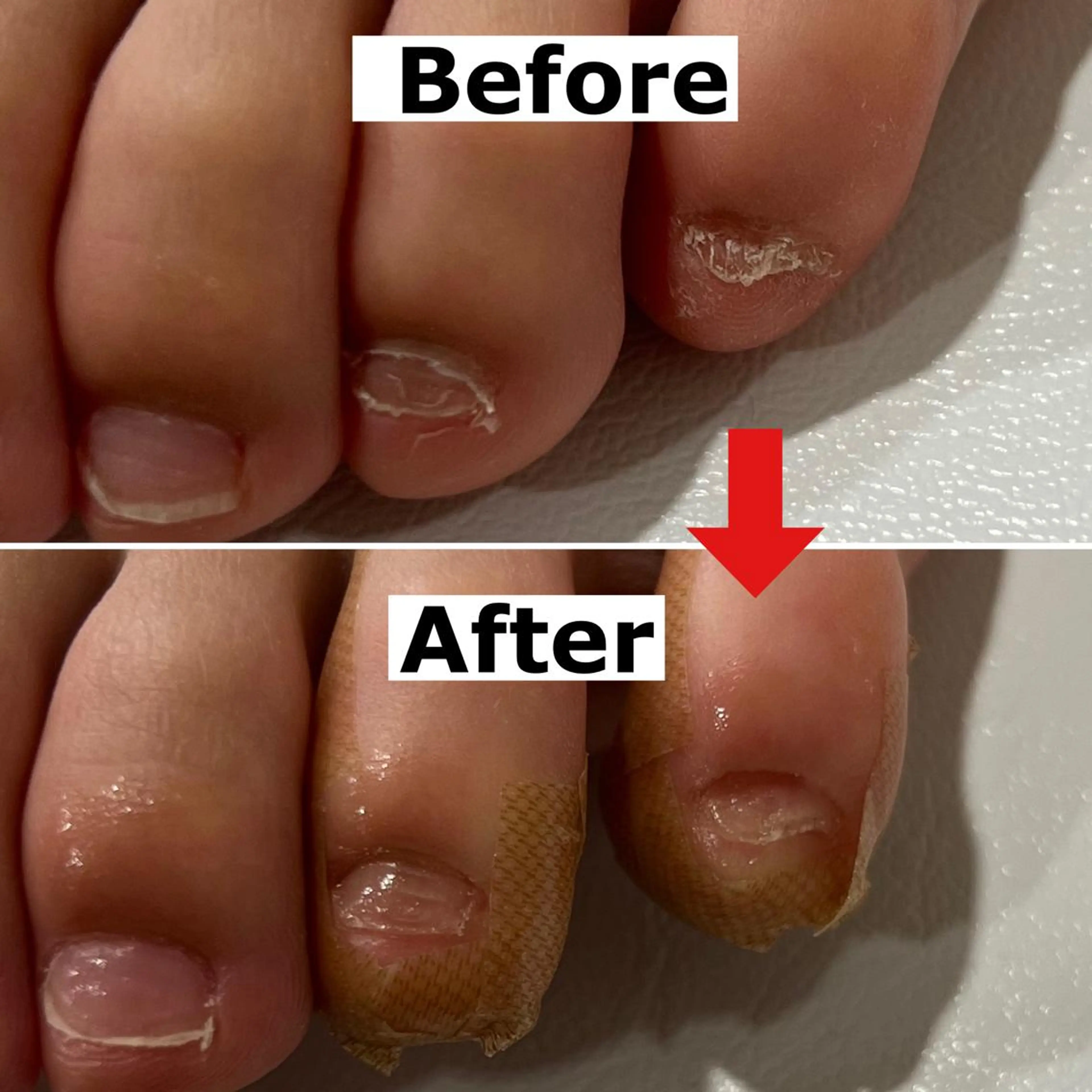 ネイル 巻爪無料モデル募集 ✨🦶MEGUMIのネイルデザイン