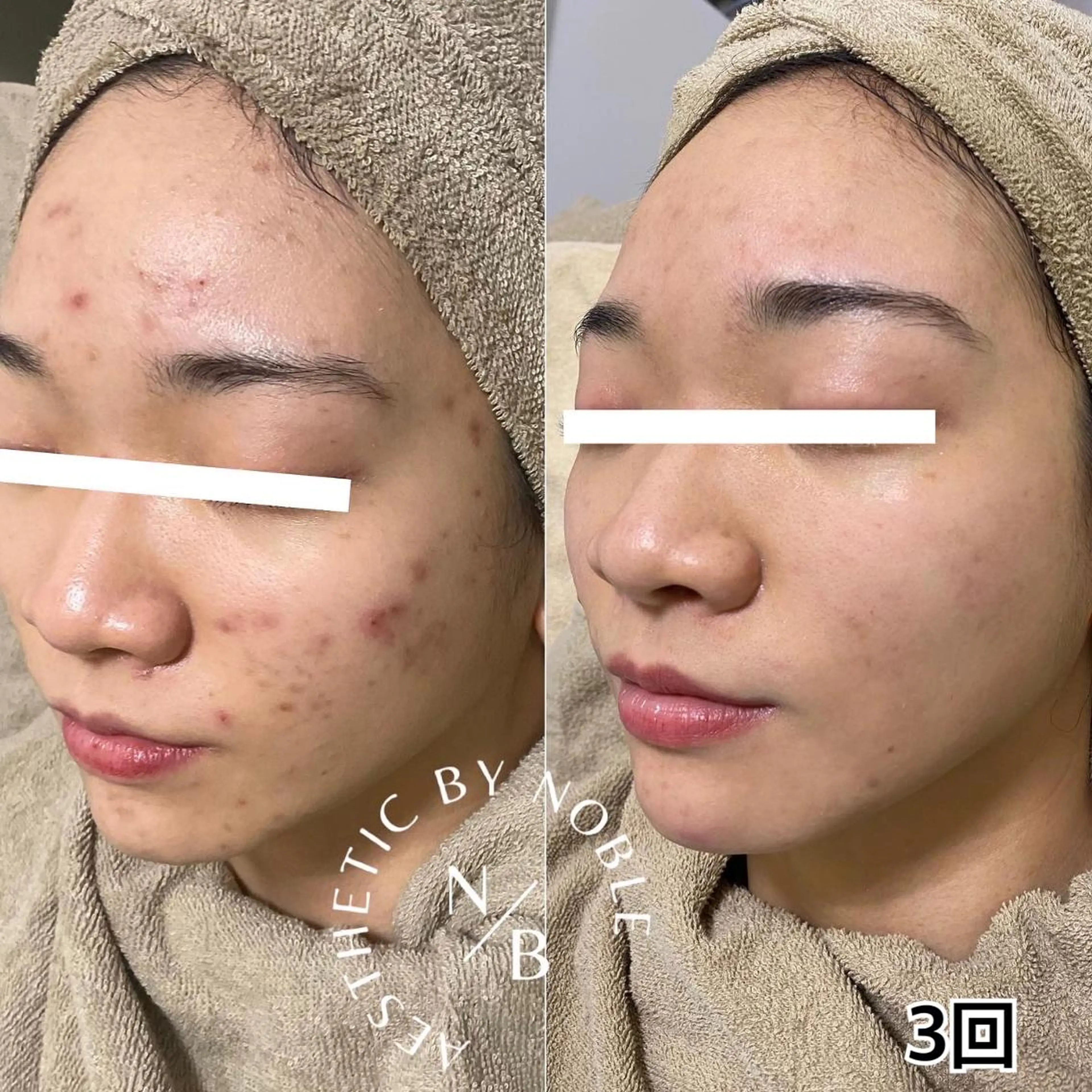 【モニター募集】【当日限定】剥離ありハーブピーリング顔 16,800円→6900円の写真