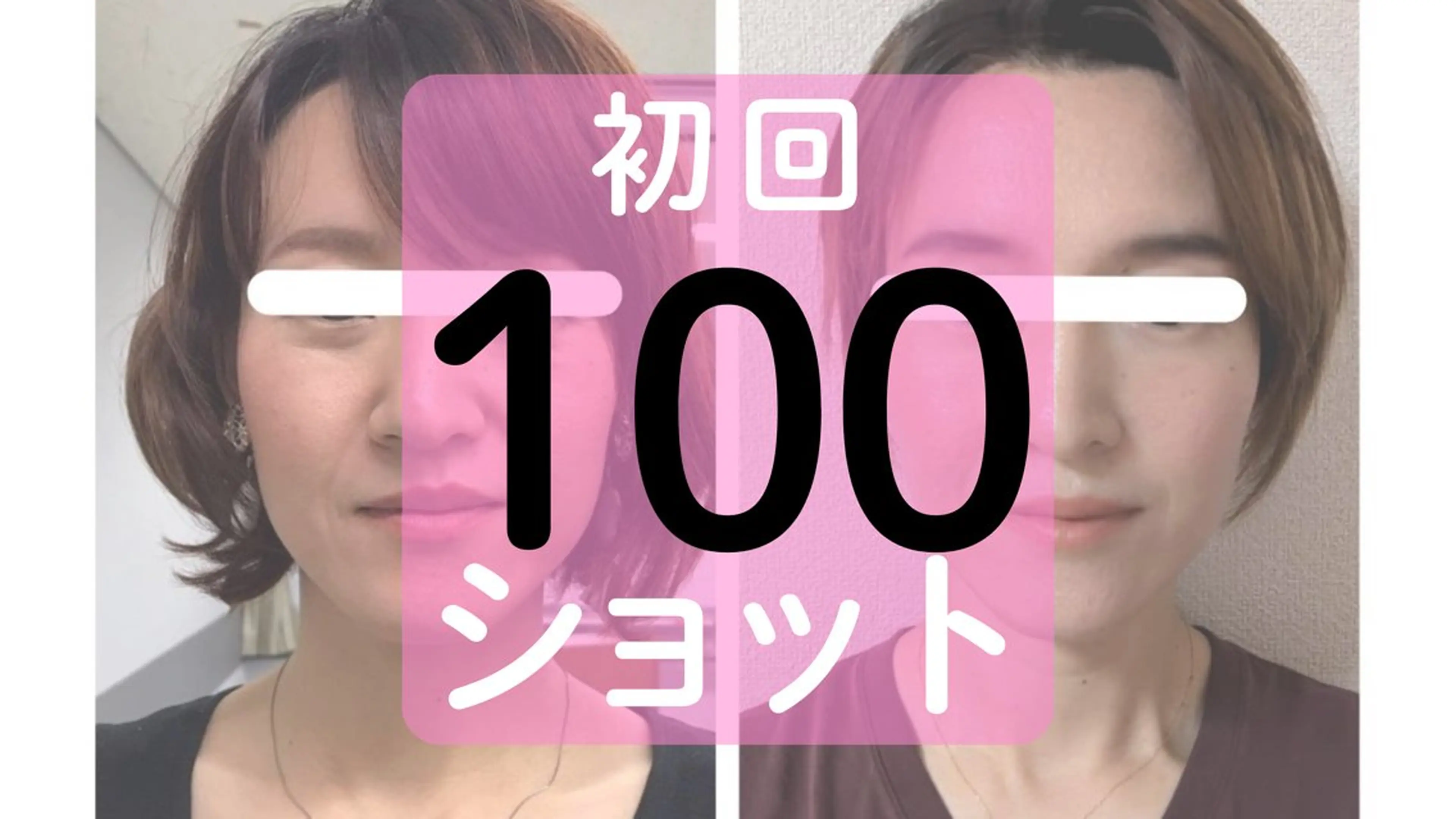 【2回目以降】シワ・シミ・くすみ・たるみから薄毛まで、お顔と頭皮のケアに 100ショットの写真