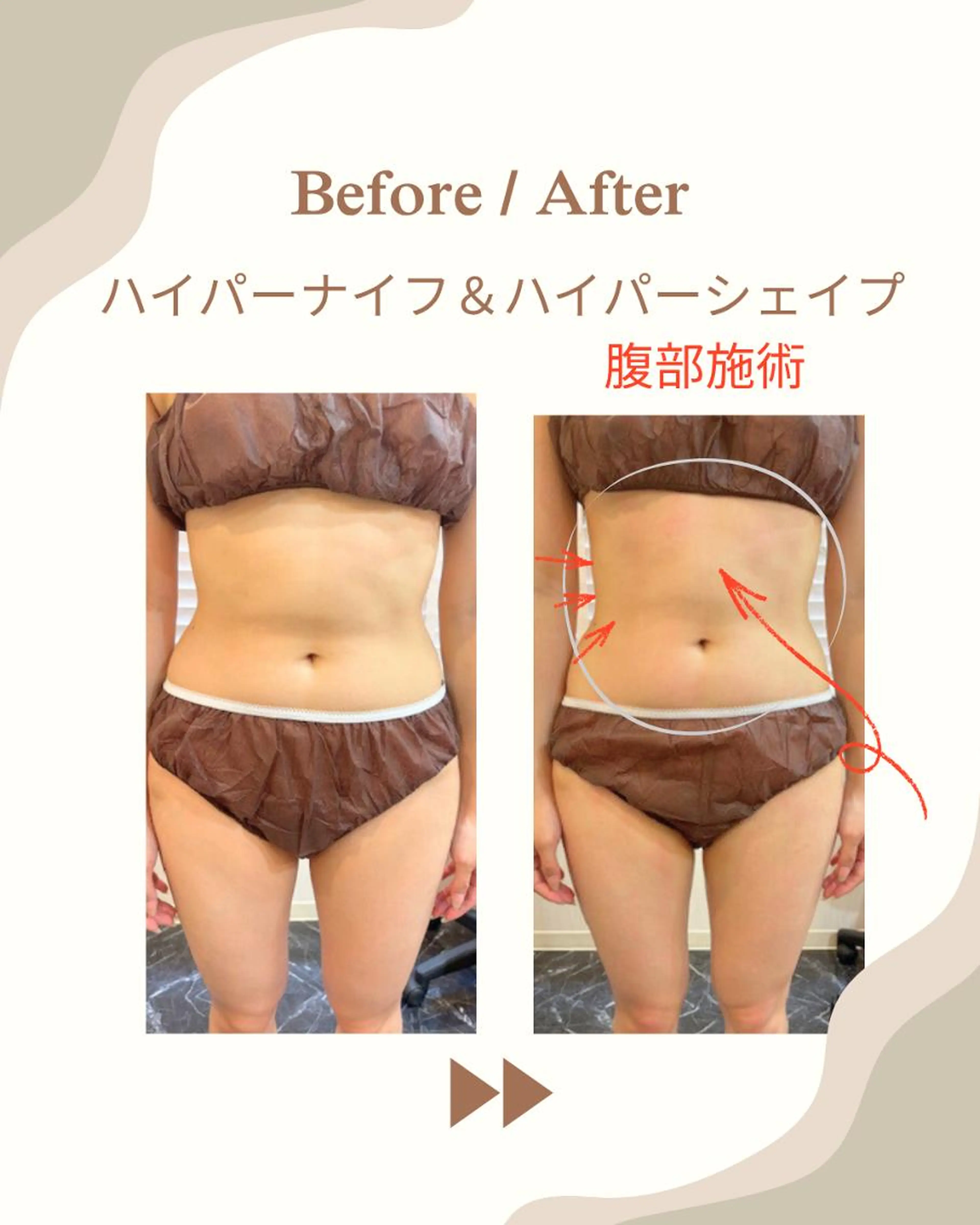 【ぽっこりお腹をすっきりさせたい方に】ハイパーナイフ20分+ハイパーシェイプ10分の写真