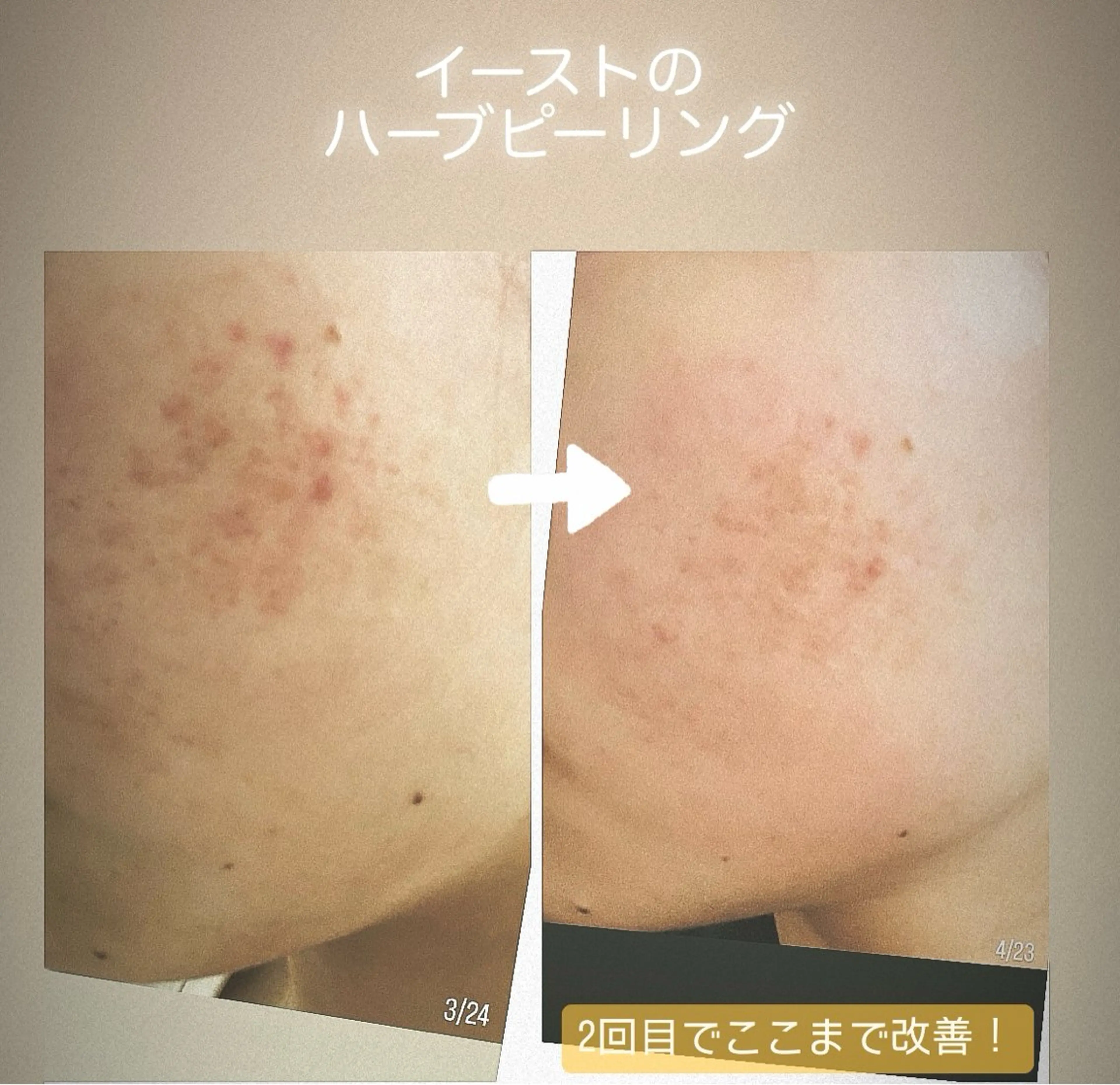 ハーブピーリング 頬だけ!額だけ!アゴだけ!お試しの写真