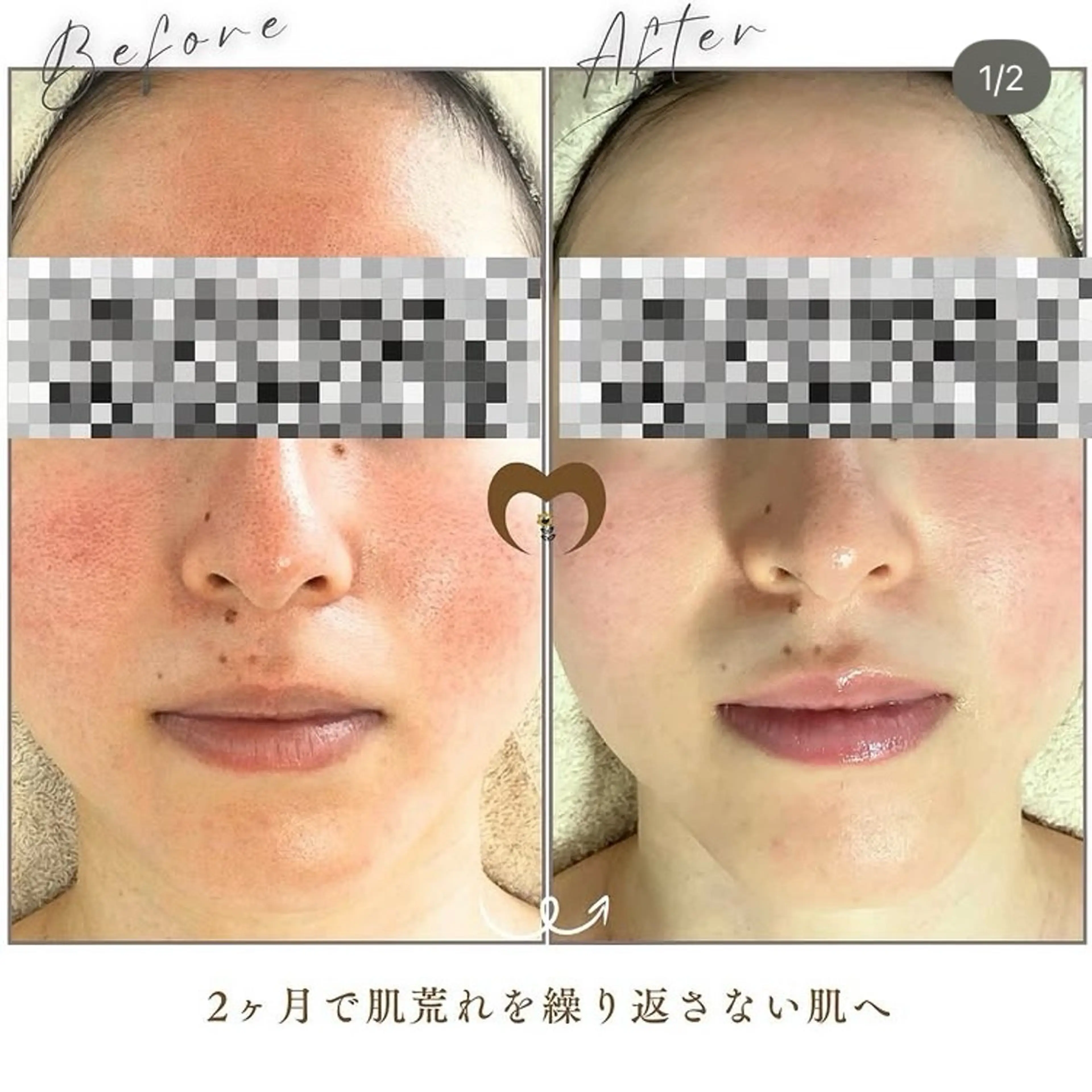 エステ リラク 繰り返すニキビ・毛穴 ✨つくば肌質改善専門のエステ・リラクイメージ