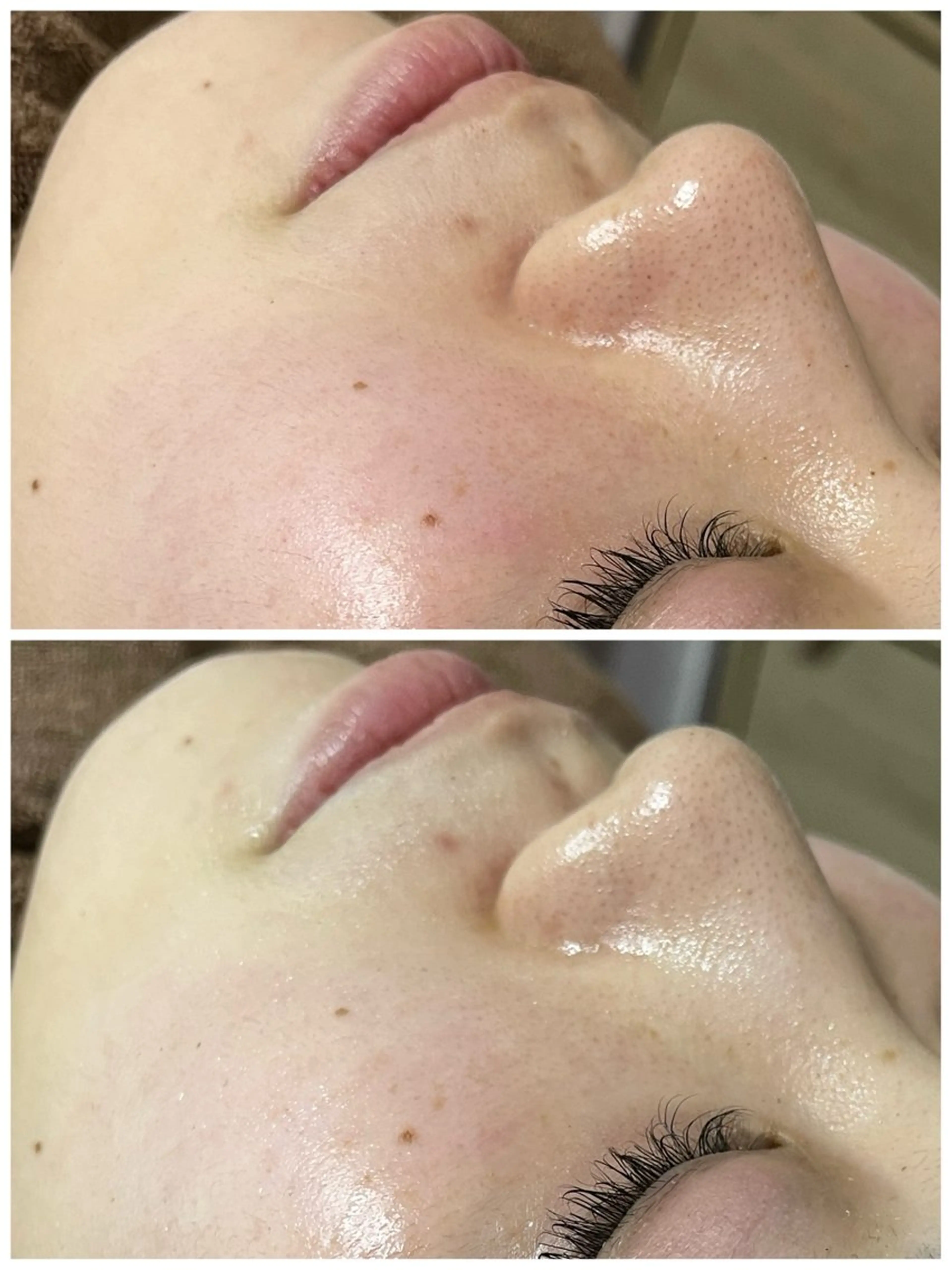 ニキビ／毛穴ケア ハーブピーリングのエステ・リラクイメージ