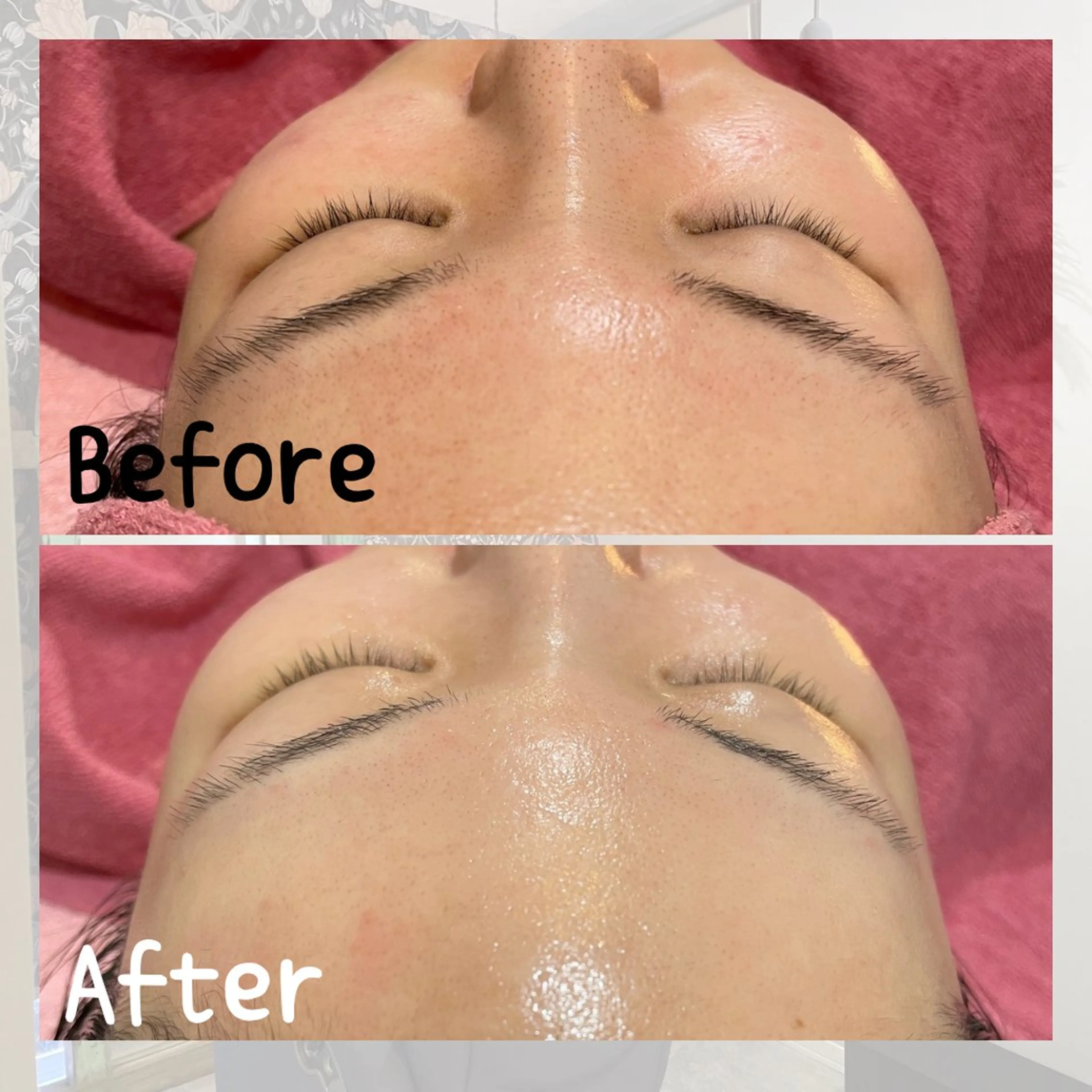 口コミしてくれる方限定✨20%OFF✨シェービング🪞＋ハーブピーリング🌿＋酵素パック💆‍♀️の写真