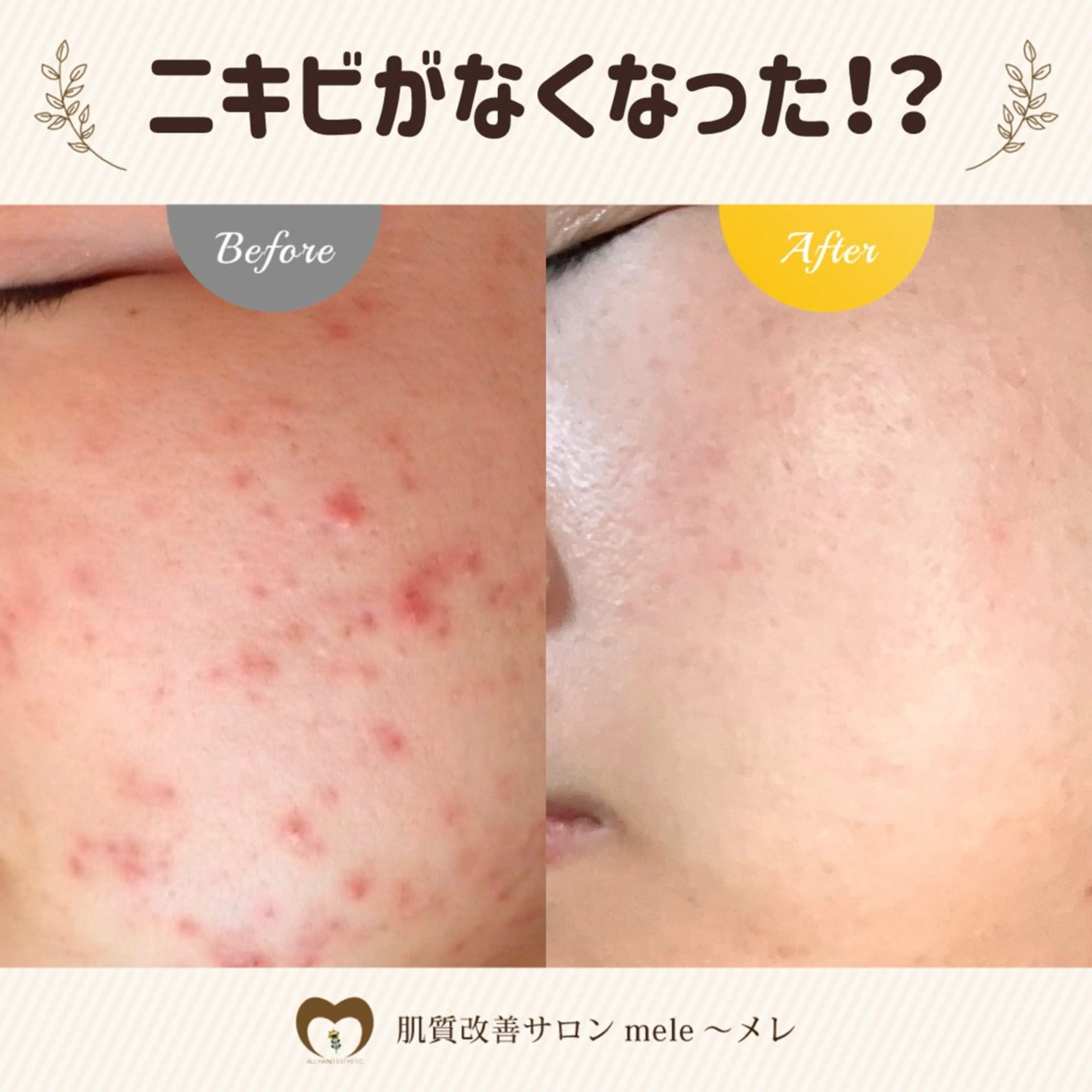 繰り返すニキビ・毛穴 ✨つくば肌質改善専門のエステ・リラクイメージ