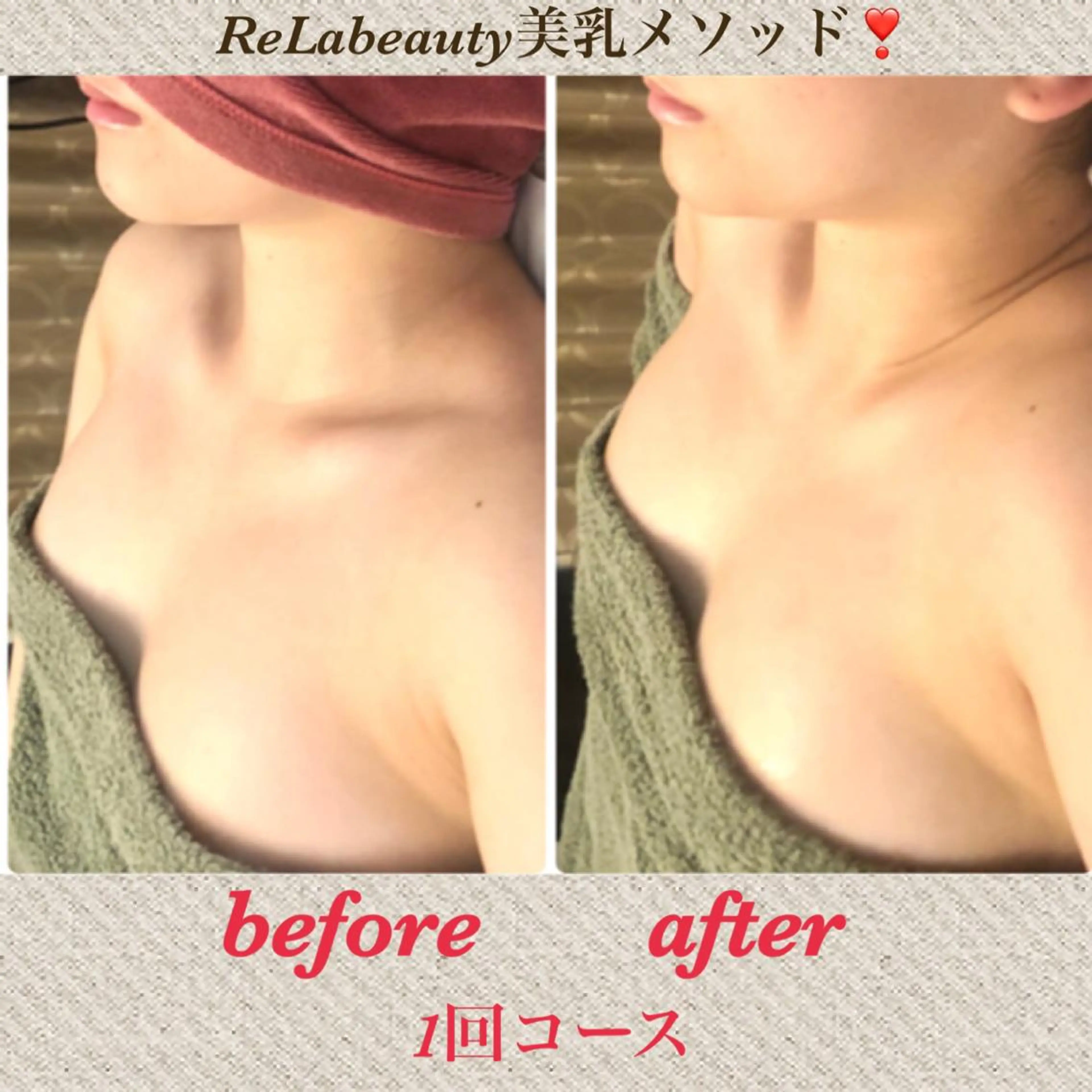 姿勢矯正×光豊胸＋ナノカレントのW効果のバストアップコース❣️背中からしっかり引き上げ、ワキ肉もスッキリ✨の写真