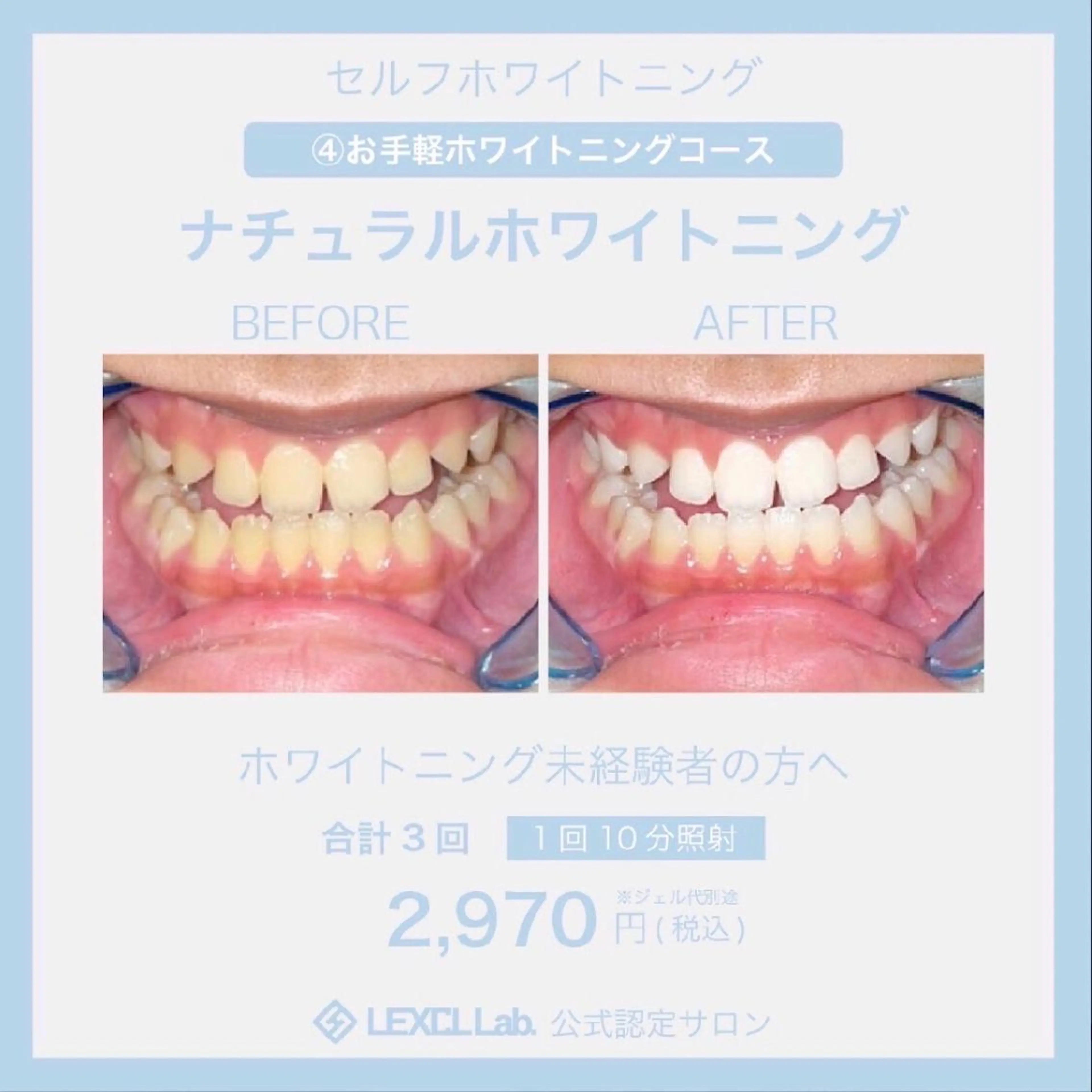 【初回限定】自然な歯本来のピカピカの白さを目指していきます😁〈30分照射コース〉の写真