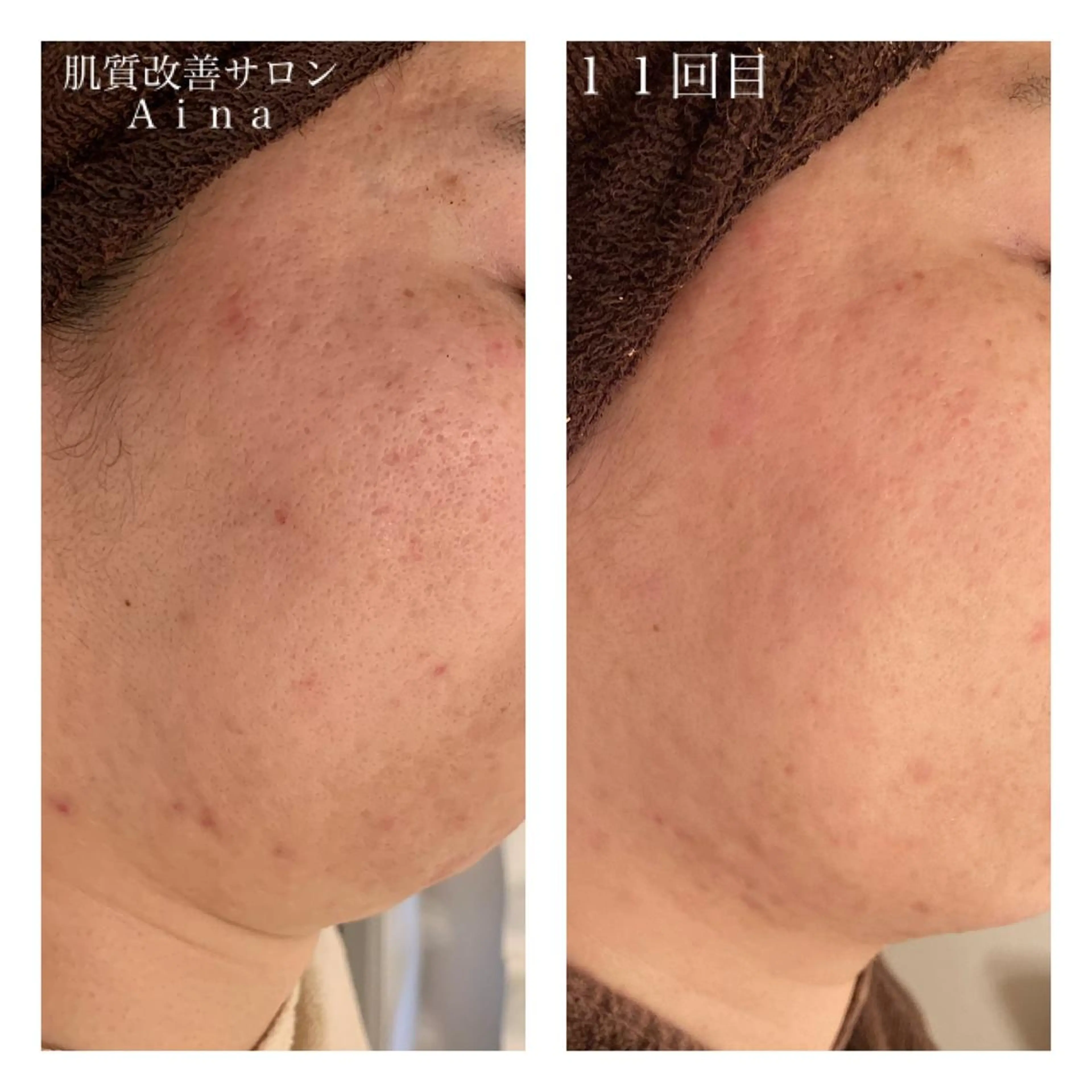 ショート カラー パーマ ヘアアレンジ メンズ キッズ ネイル マツエク・マツパ ニキビ跡専門サロン Ainaのエステ・リラクイメージ