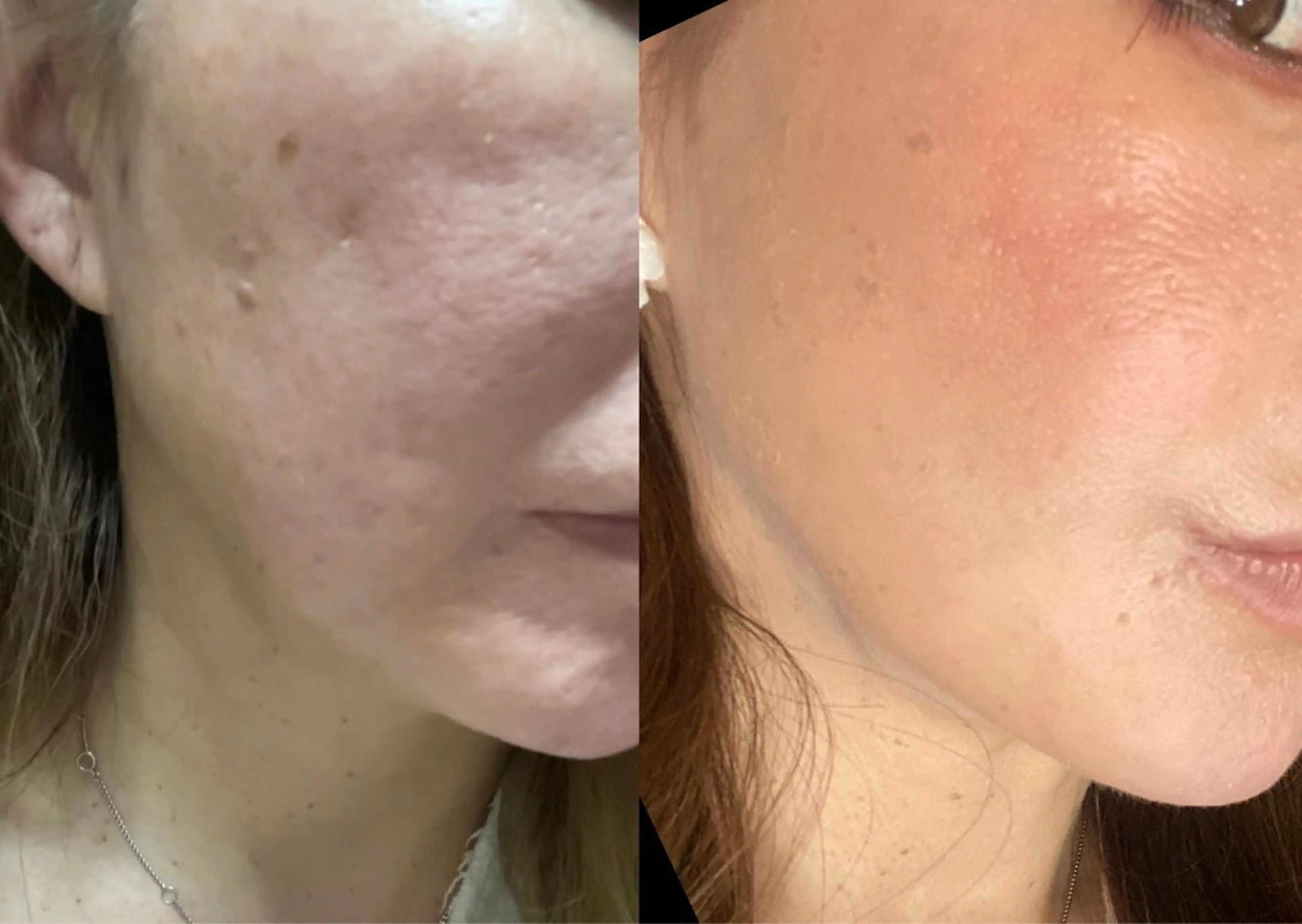 ハーブピーリング 脱毛専門店ALTOのエステ・リラクイメージ