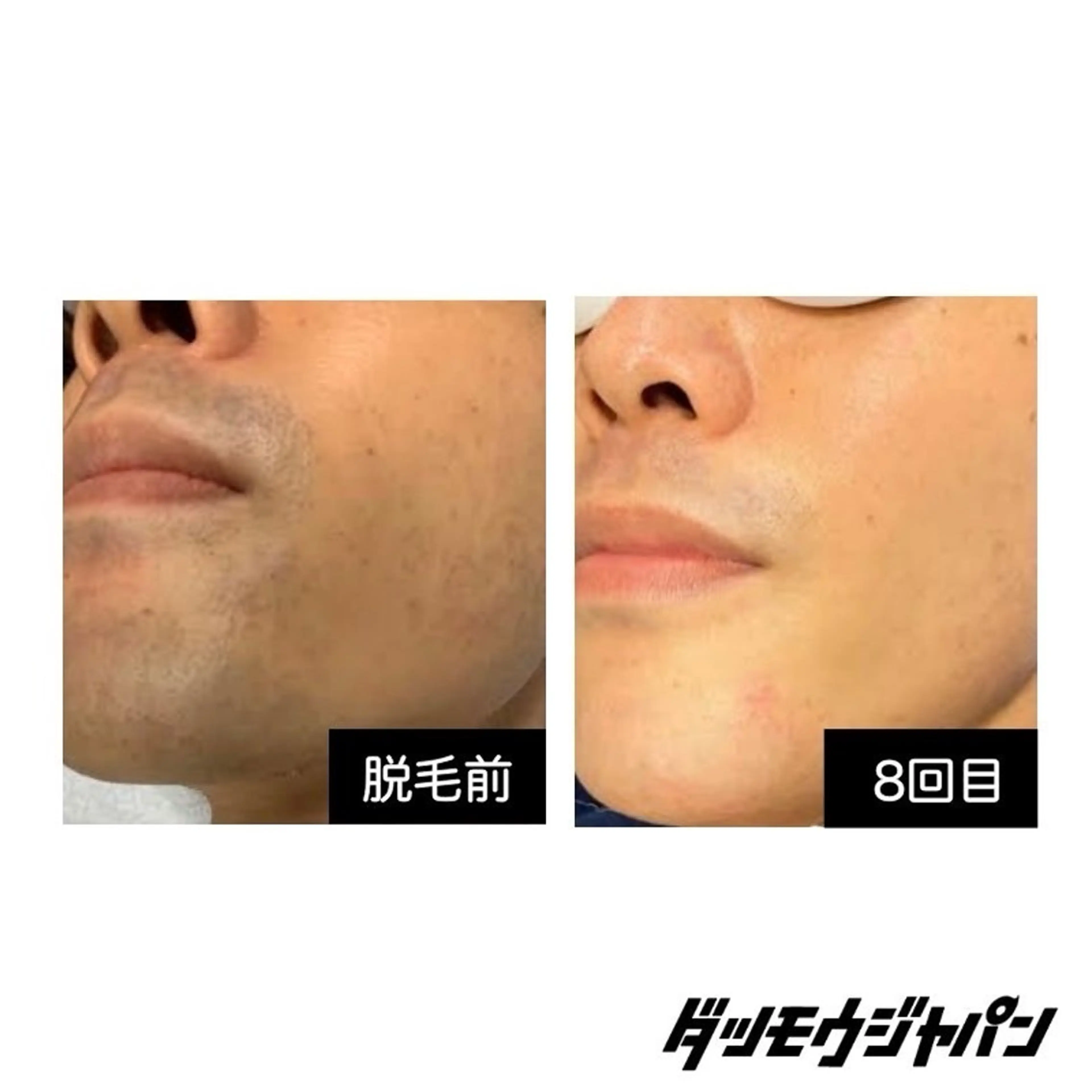 ヒゲ脱毛(鼻下,口下,両頬,あご,首)の写真