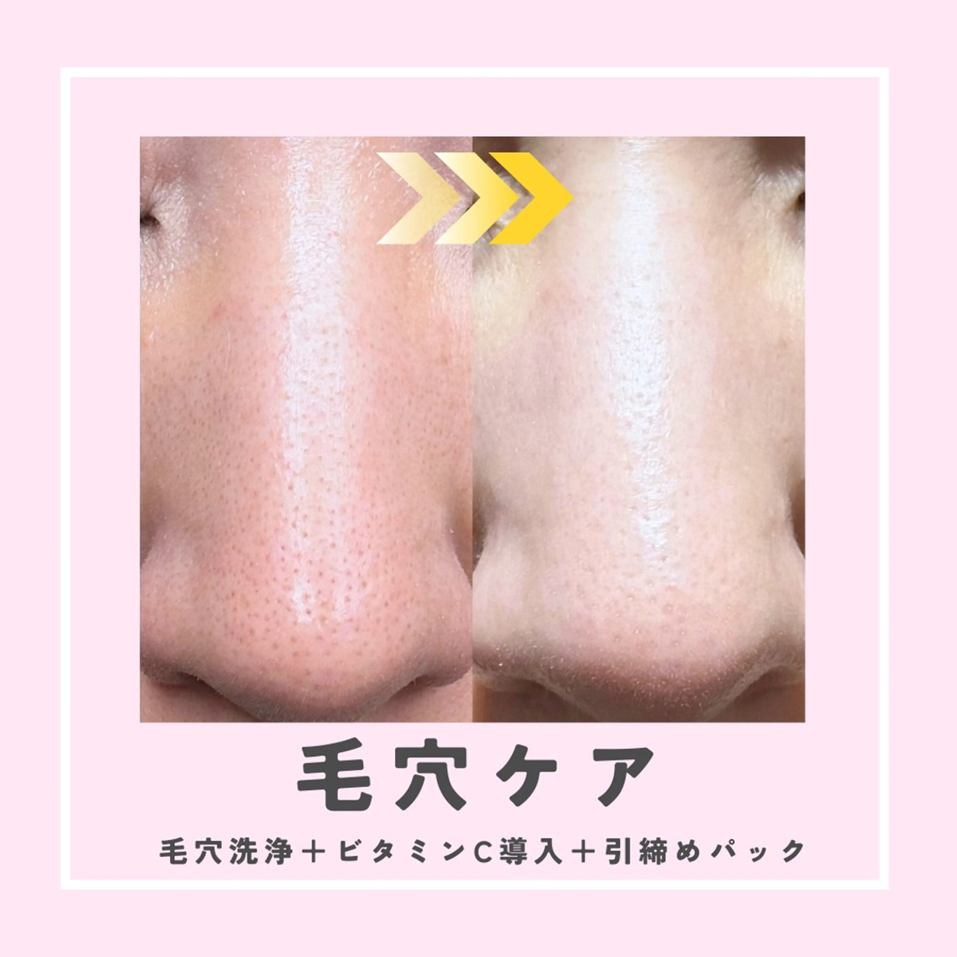 |ピーリング・毛穴| soina神楽坂のエステ・リラクイメージ