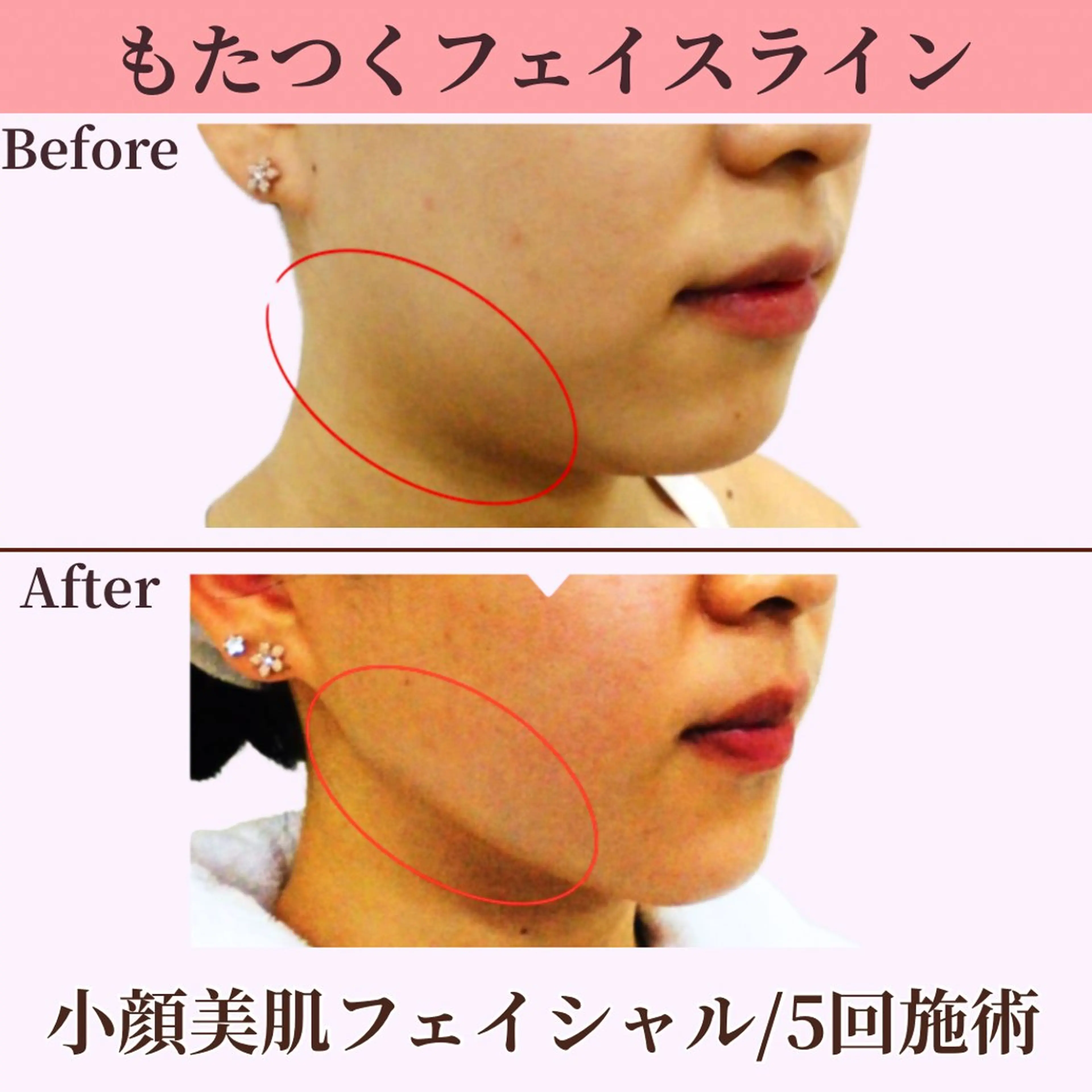 【小顔×美肌フェイシャル】驚きの小顔施術でもたついたフェイスラインもスッキリ！♪デコルテ込み《初回限定💫特別価格》の写真