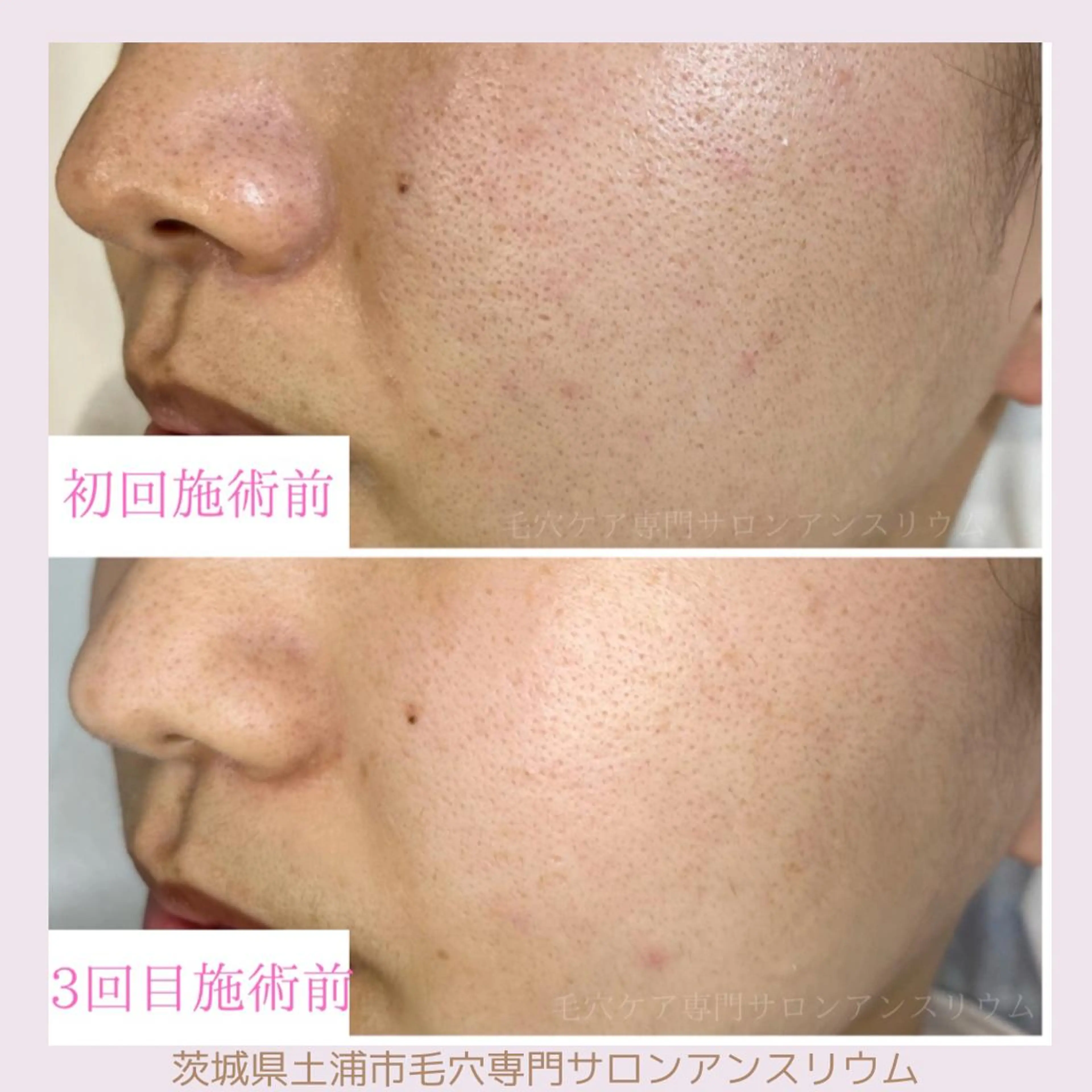 毛穴ケア専門サロンアンスリウム所属・茨城土浦 つくば毛穴 ケア専門サロンのエステ・リラクイメージ