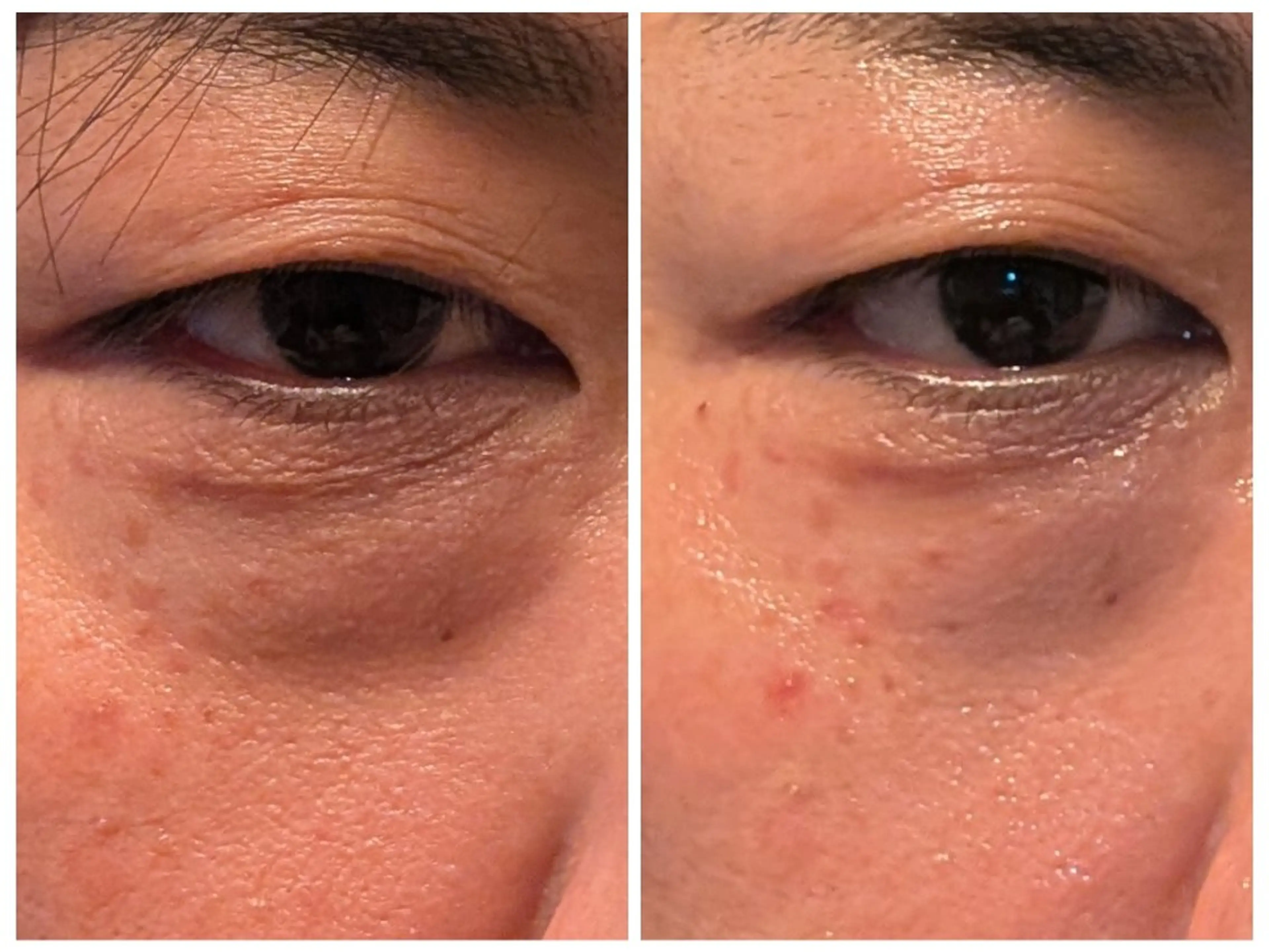 目の下のたるみケア【レッドショット】の写真