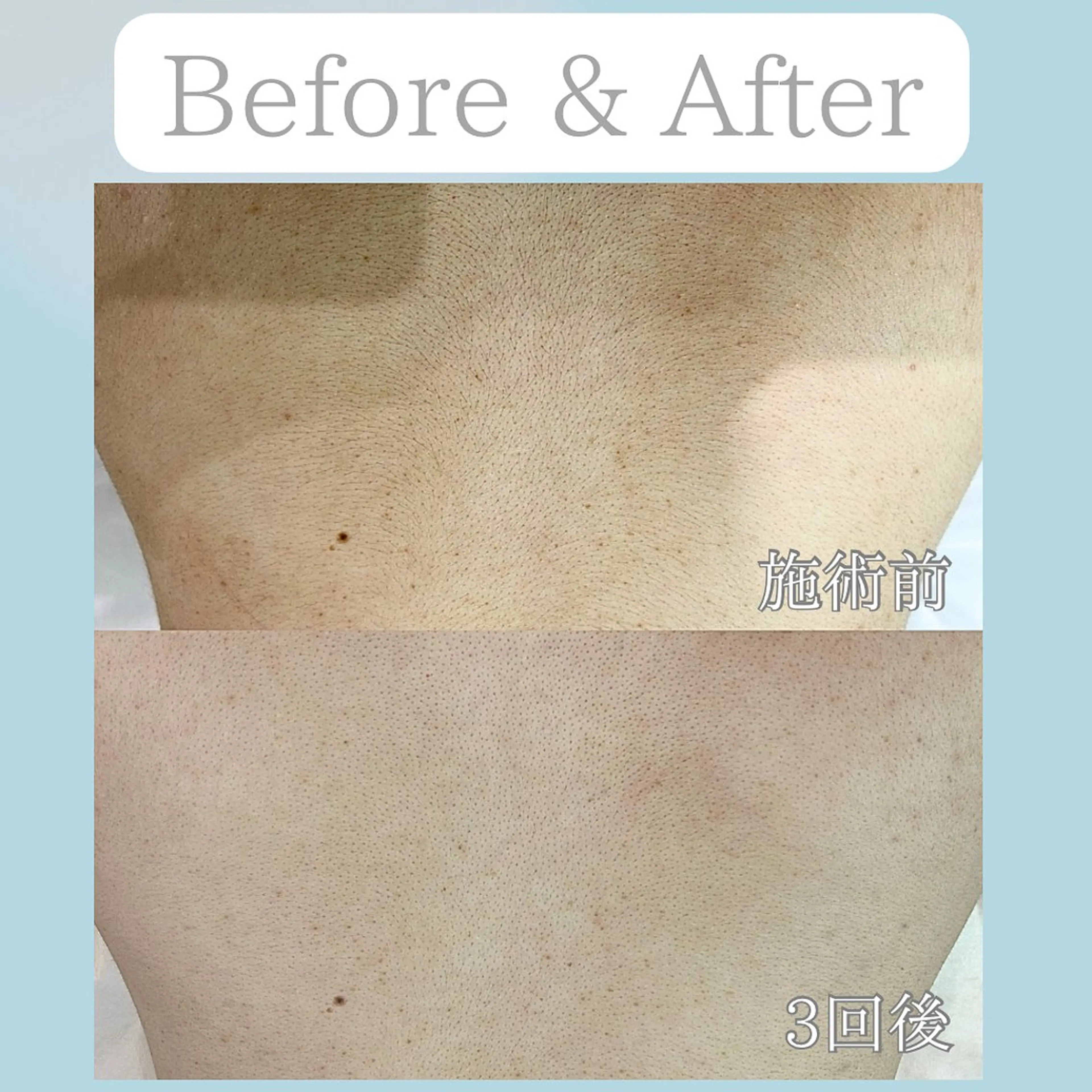 美肌脱毛&毛穴専門 Nico🐰ྀི♡のエステ・リラクイメージ