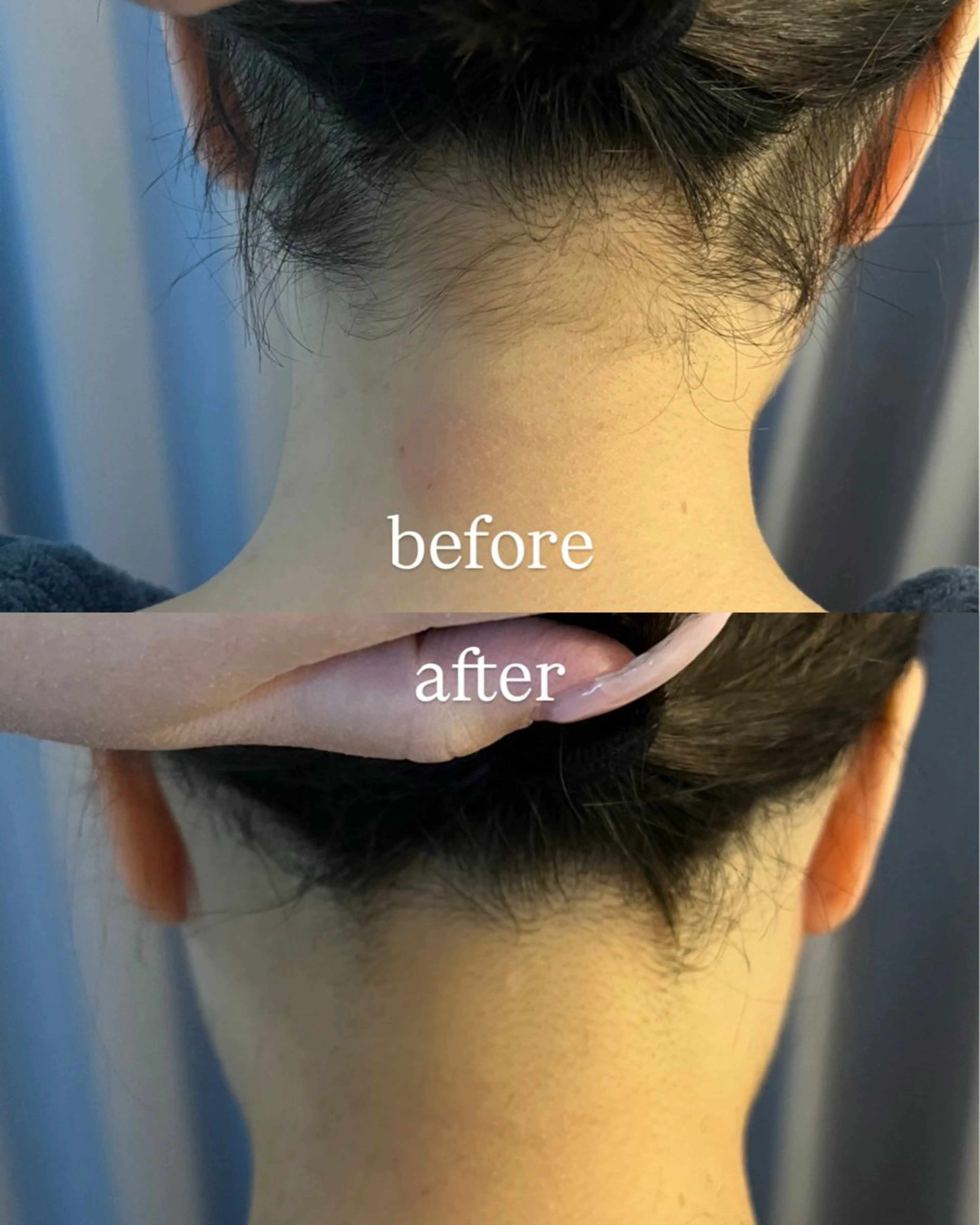 脱毛 うなじ脱毛/美肌脱毛 LABELのエステ・リラクイメージ