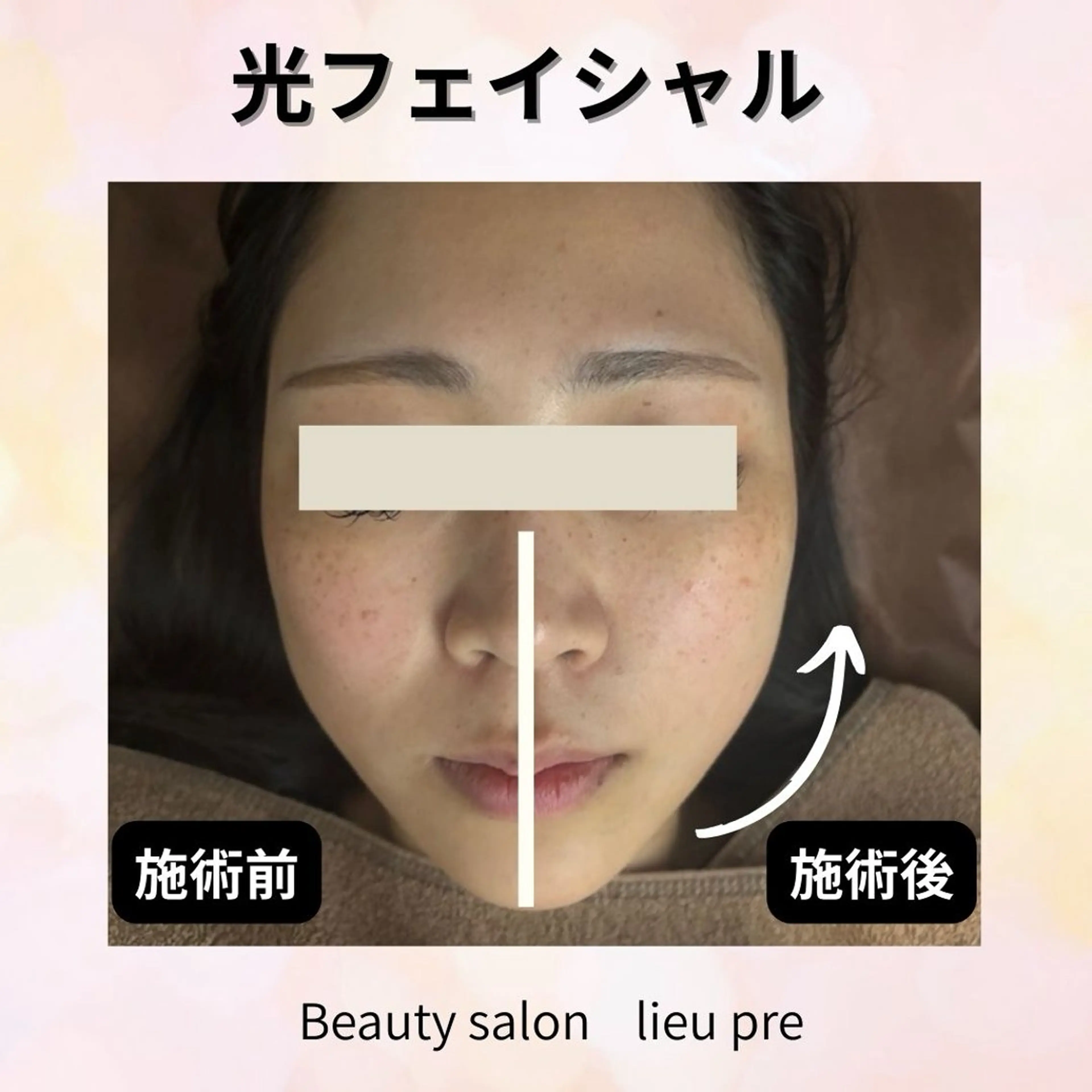 エステ lieupré 脱毛 oshima‎⌣̈のエステ・リラクイメージ