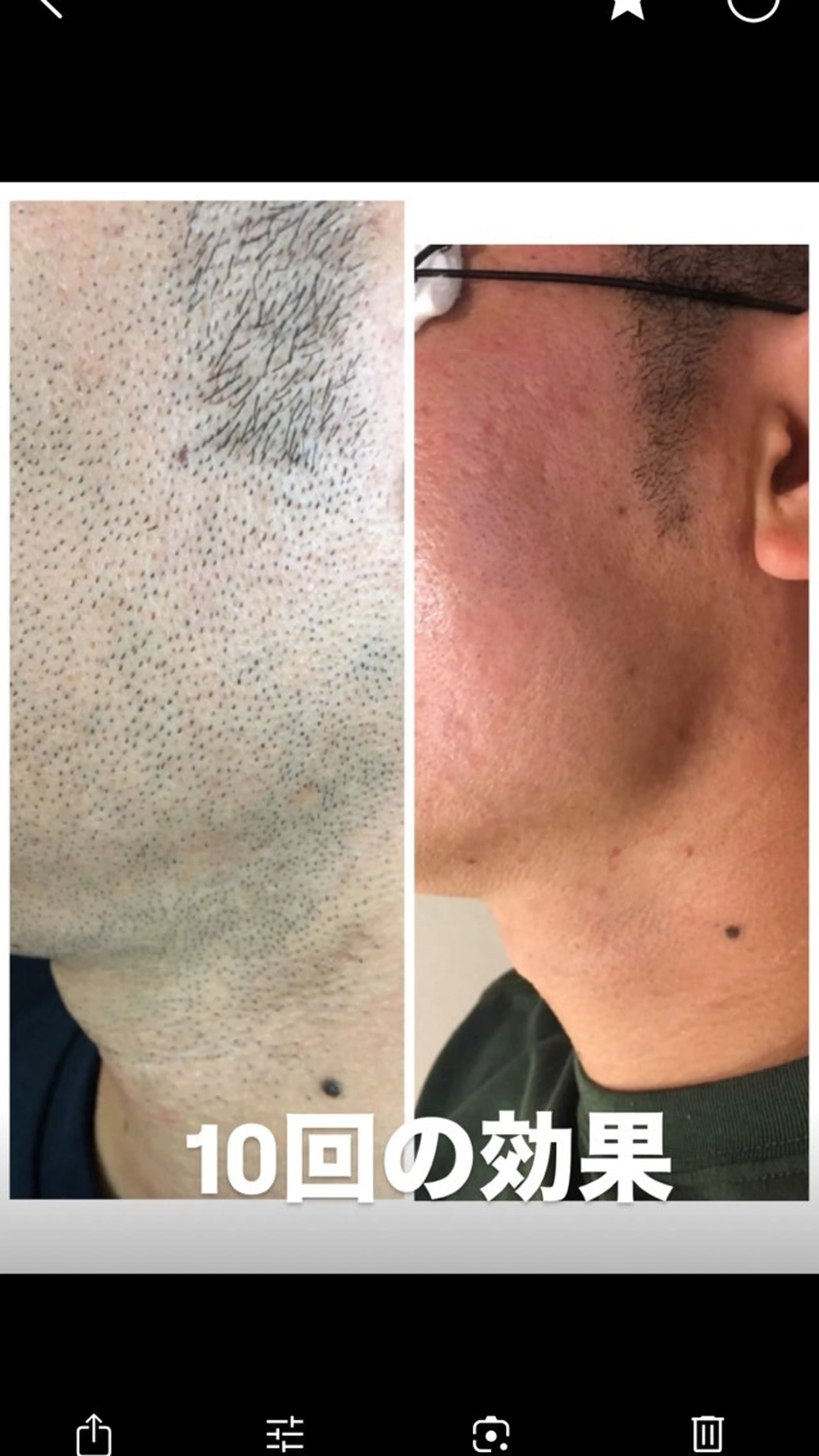 【剛毛のウチナー男子も、ツルピカ美肌に⭐️】メンズ髭脱毛の写真