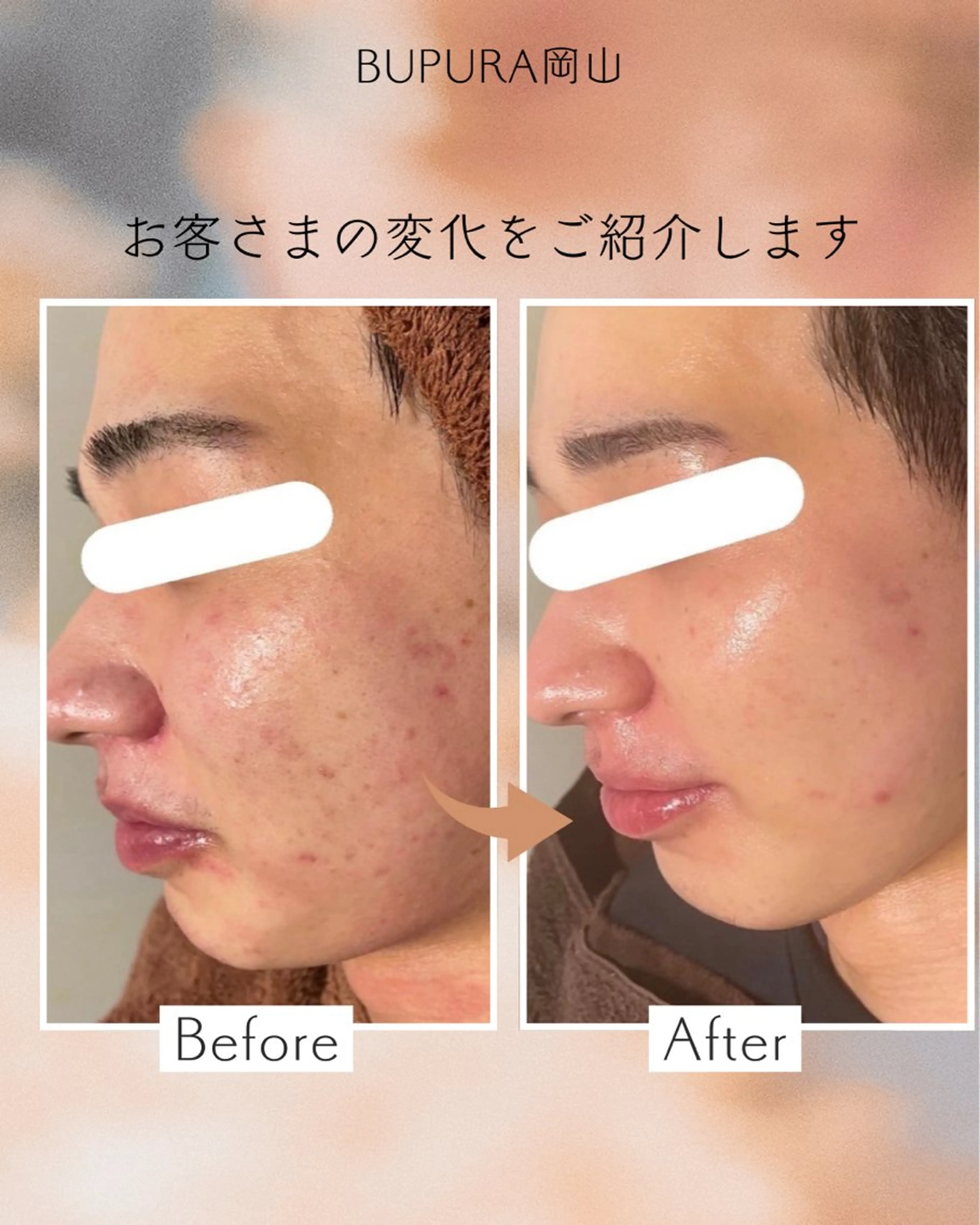 小顔矯正＆肌質改善 BUPURA岡山のエステ・リラクイメージ