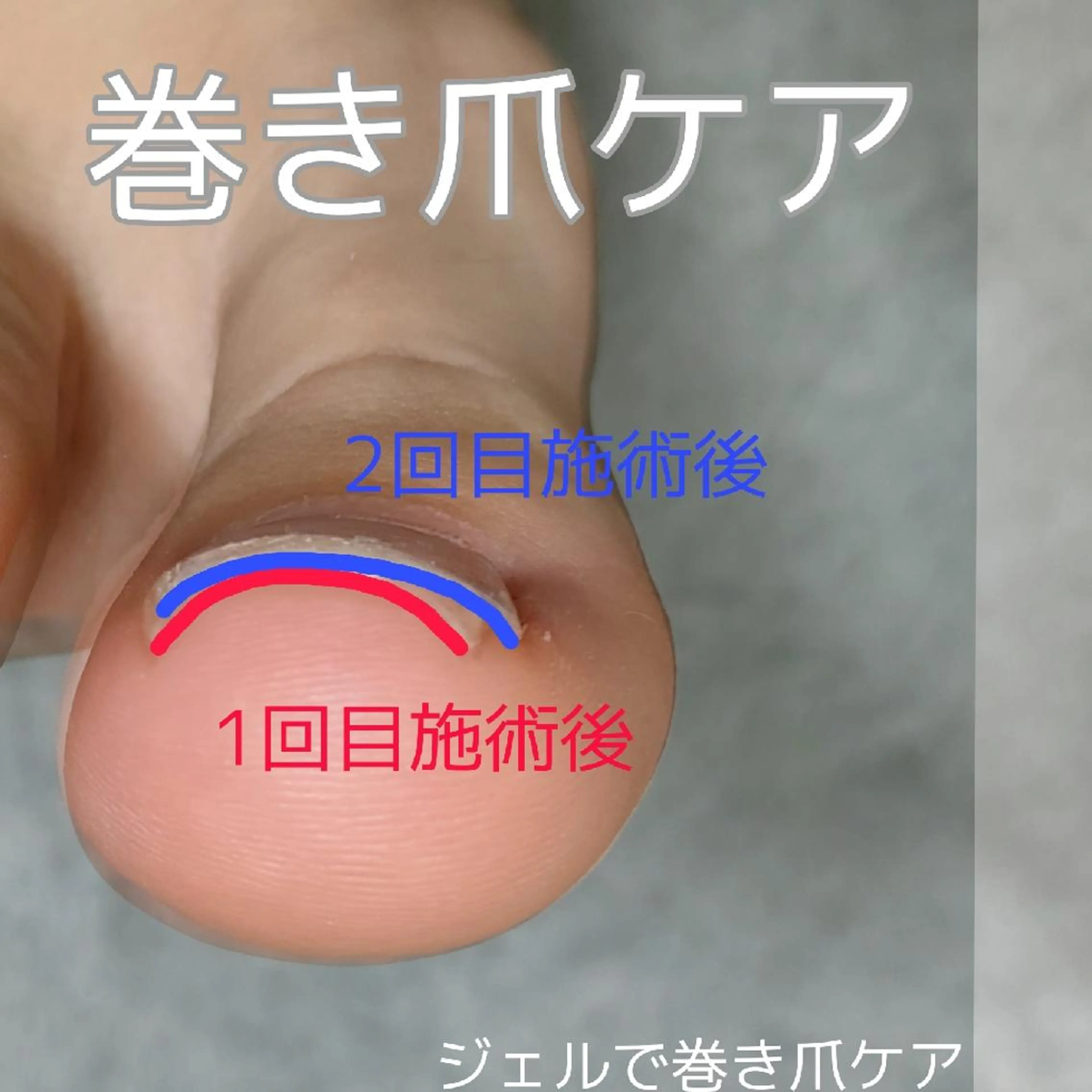 機能性特殊ジェルで巻き爪ケア👣韓国より上陸Hey Switch親指1本※要詳細確認の写真