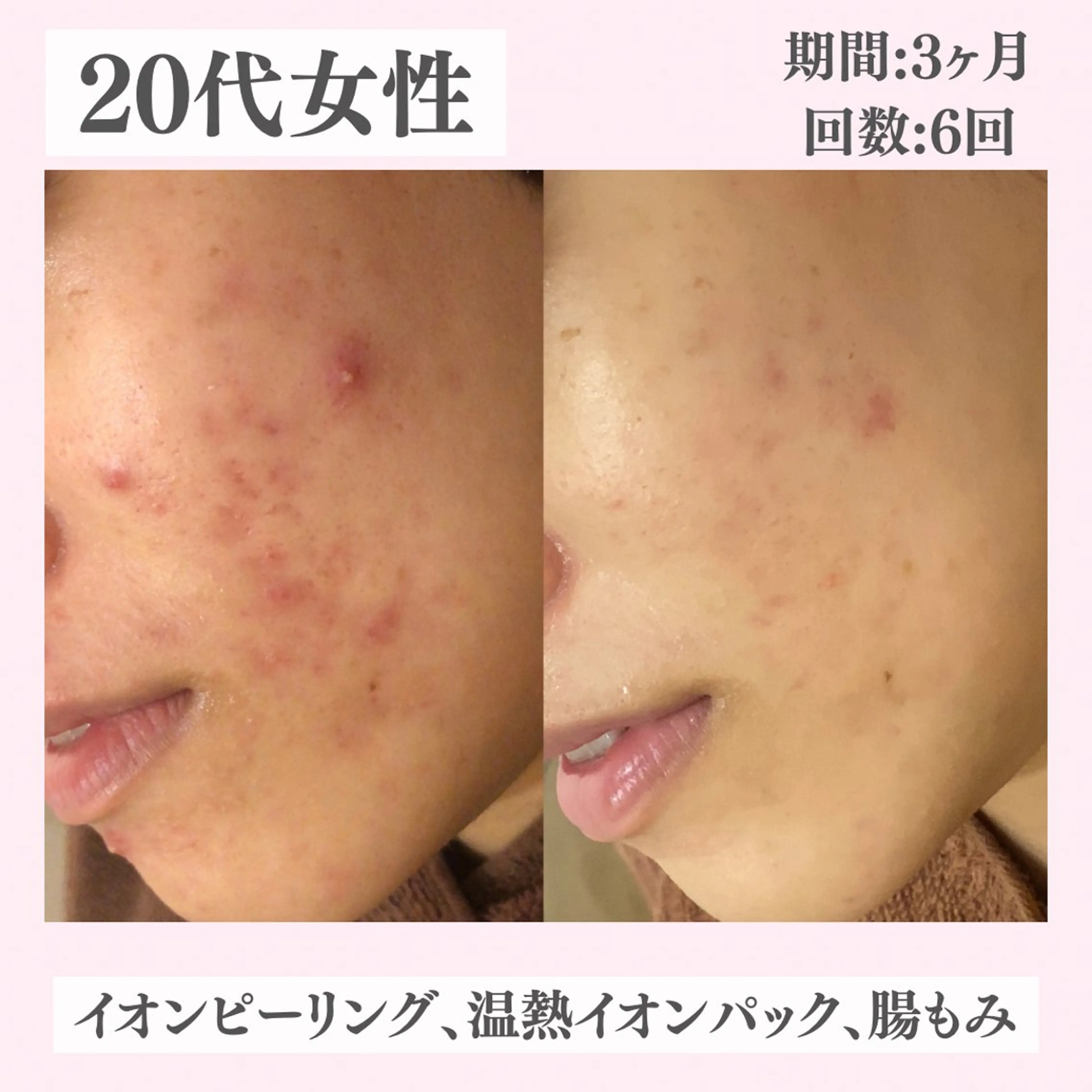 エステ リラク ニキビ・肌質改善専門 ♡人生が変わるサロンのエステ・リラクイメージ