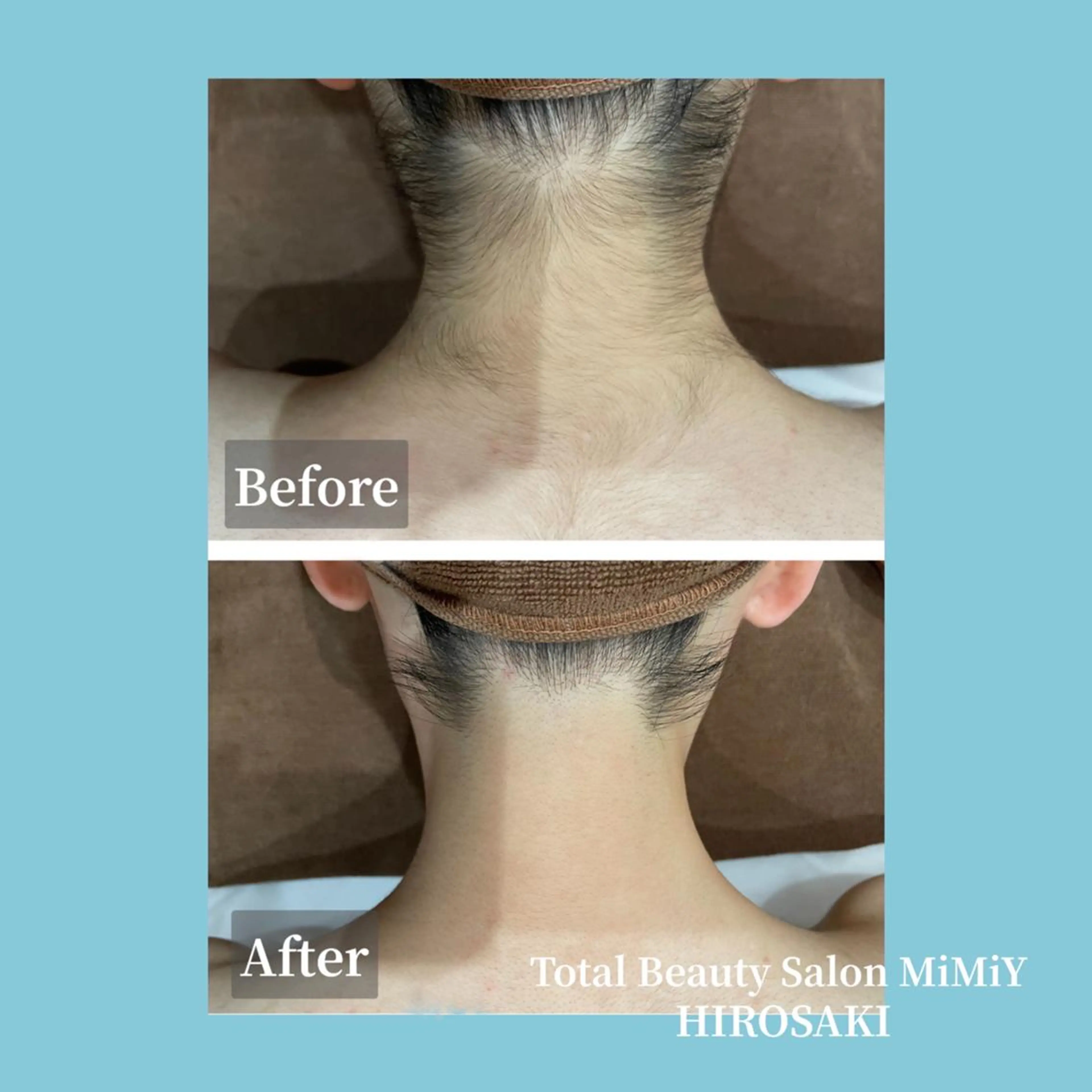 後ろ姿に自信◎うなじ脱毛【女性】60分の写真