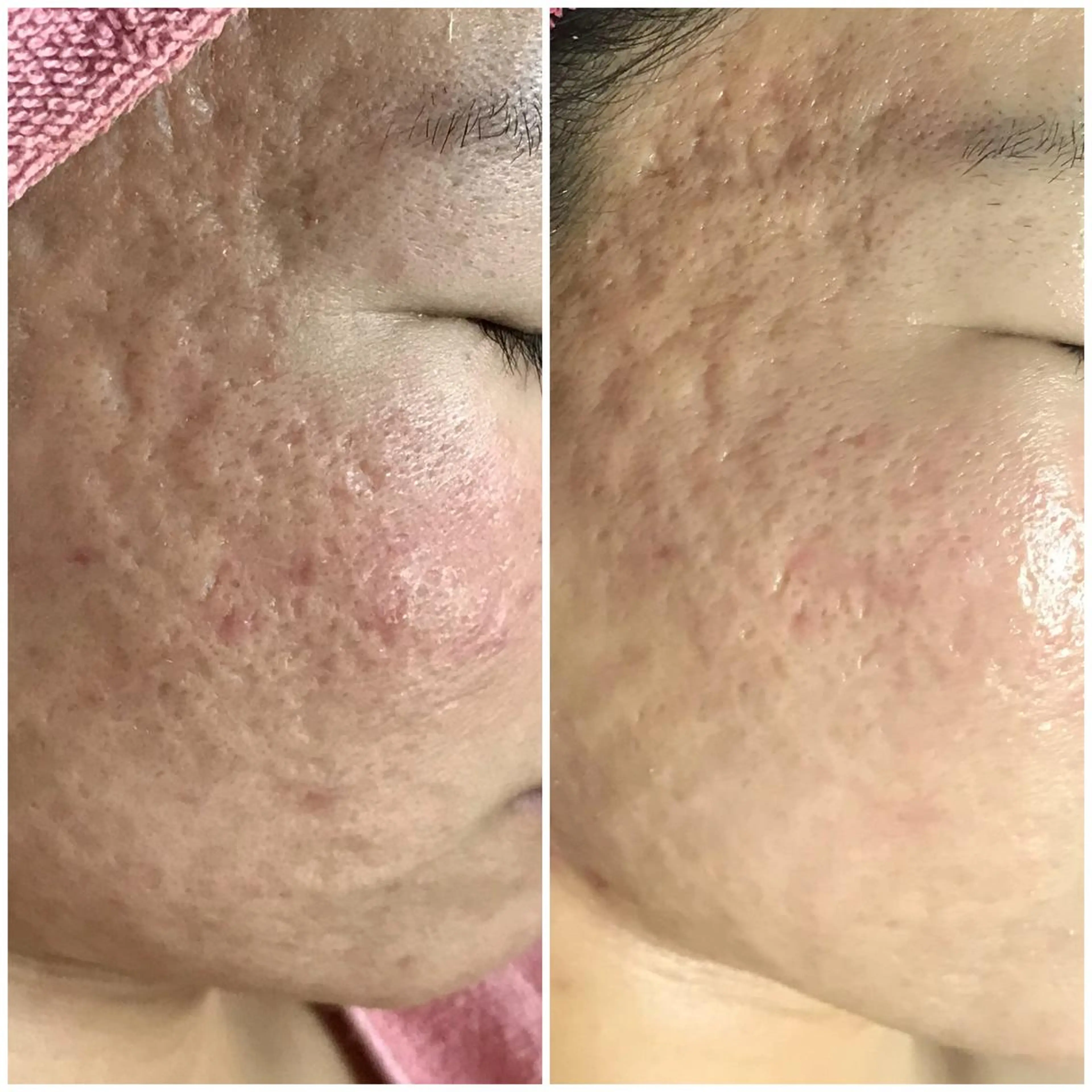 高速脱毛エステ リアンのエステ・リラクイメージ